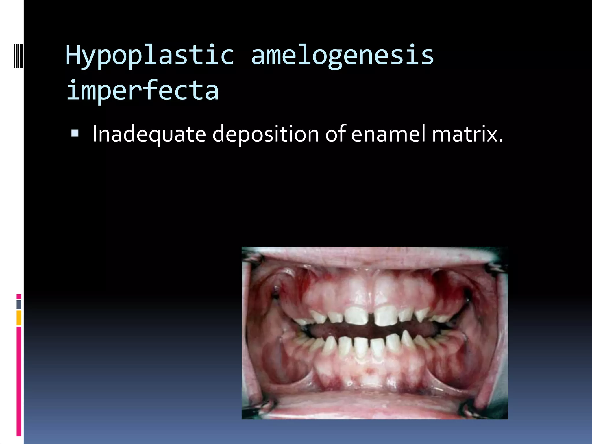 Hypoplastic amelogenesis
imperfecta
 Inadequate deposition of enamel matrix.
 