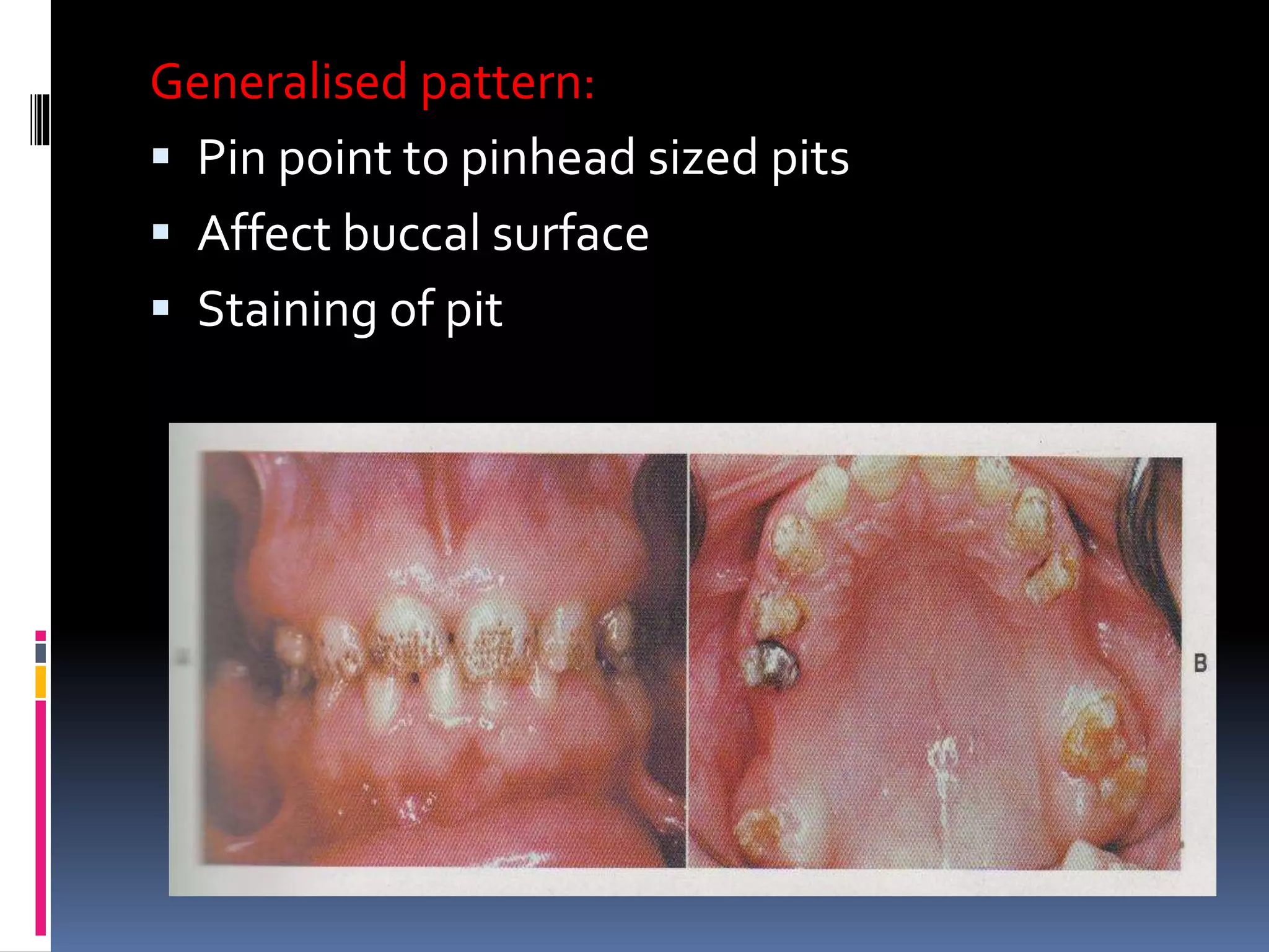 Generalised pattern:
 Pin point to pinhead sized pits
 Affect buccal surface
 Staining of pit
 