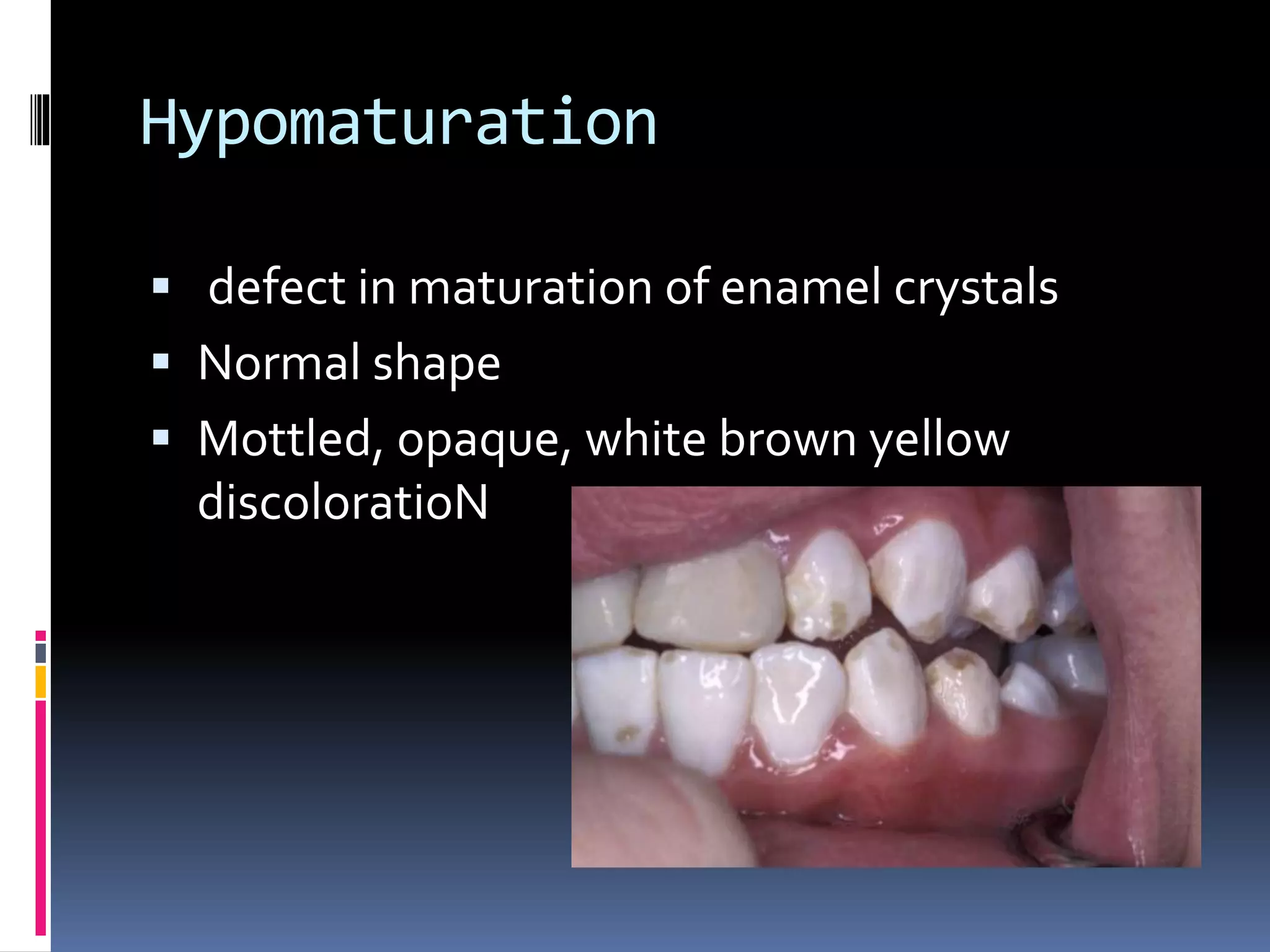 Hypomaturation
 defect in maturation of enamel crystals
 Normal shape
 Mottled, opaque, white brown yellow
discoloratioN
 