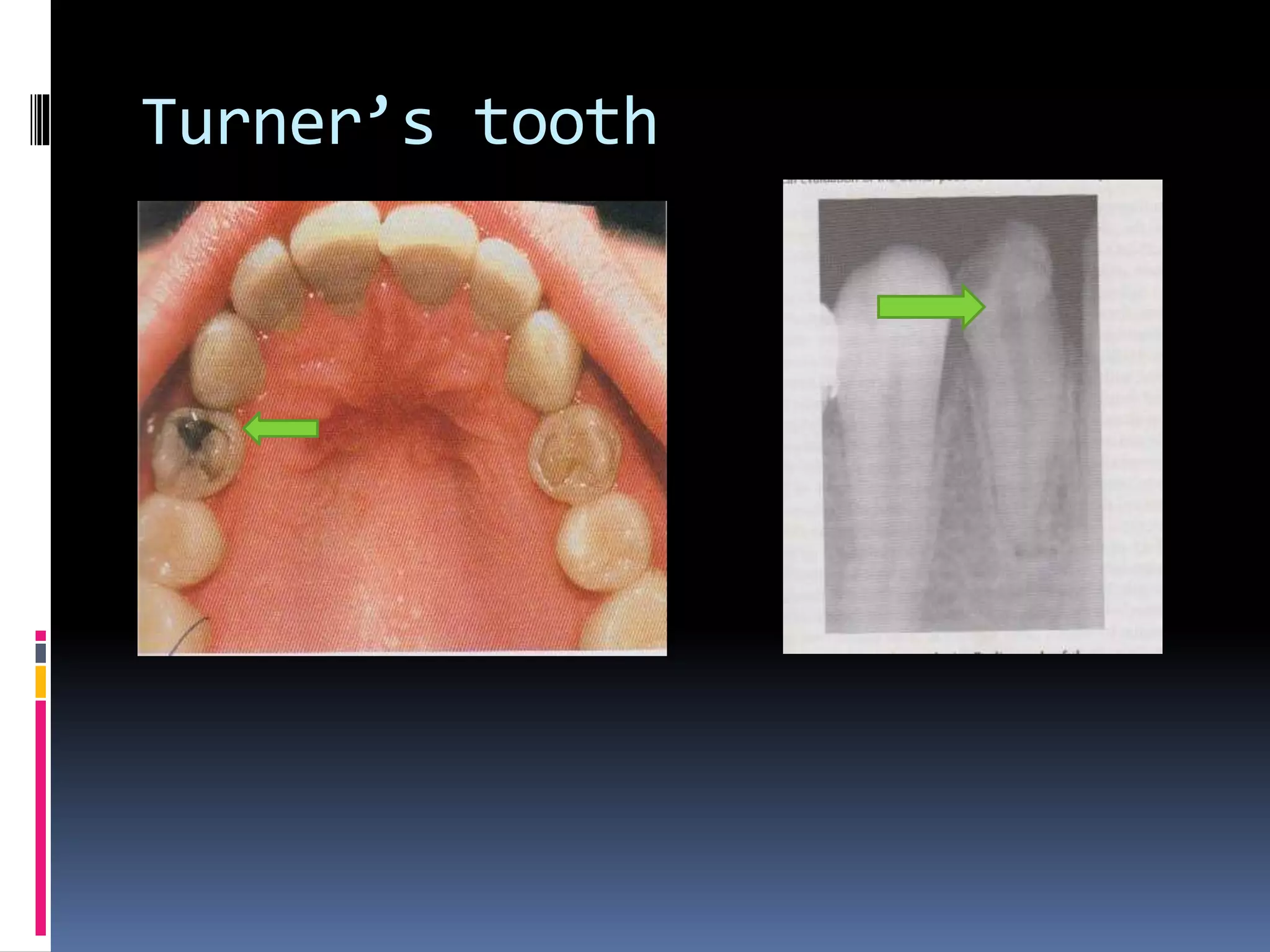 Turner’s tooth
 