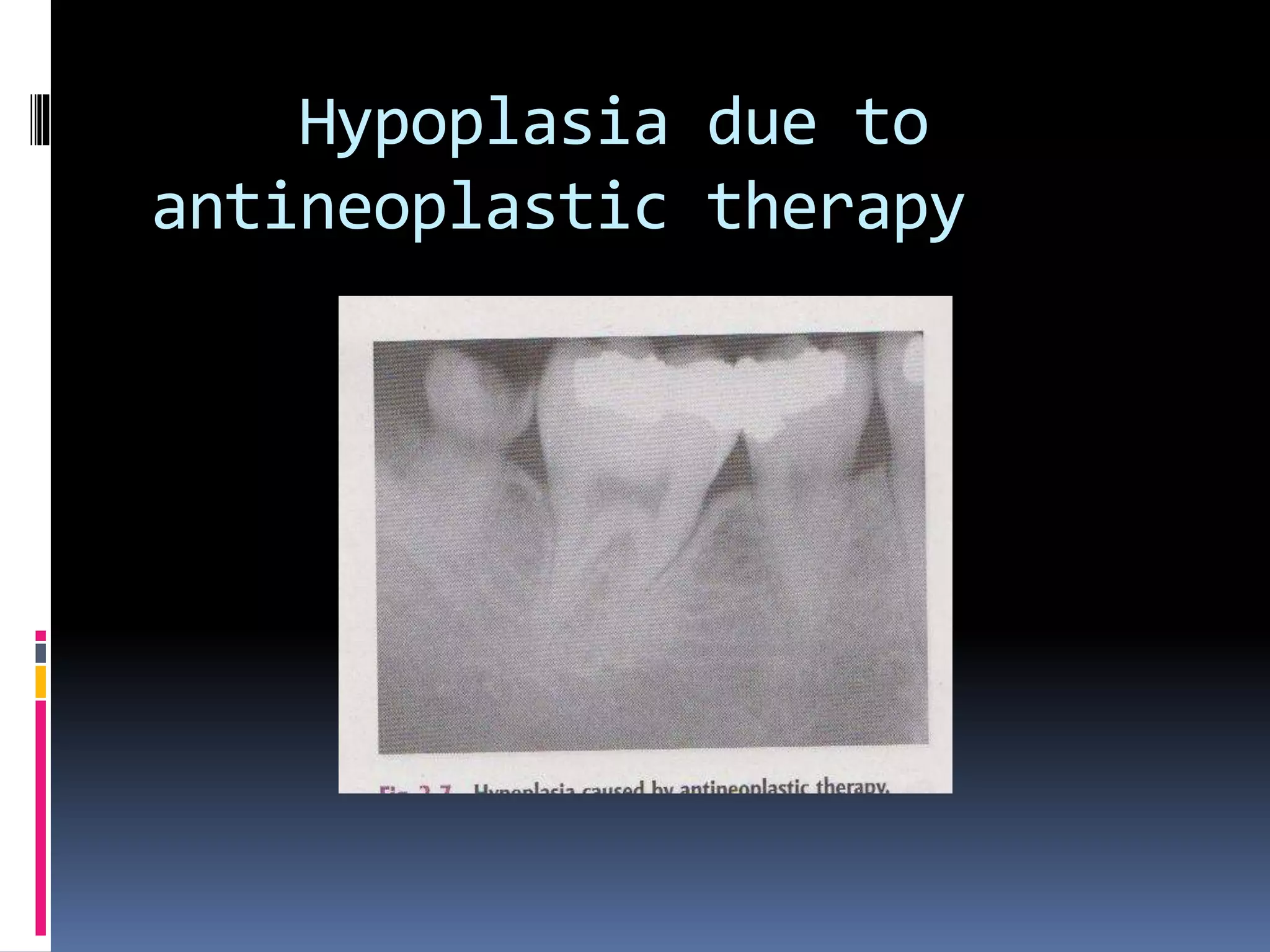 Hypoplasia due to
antineoplastic therapy
 