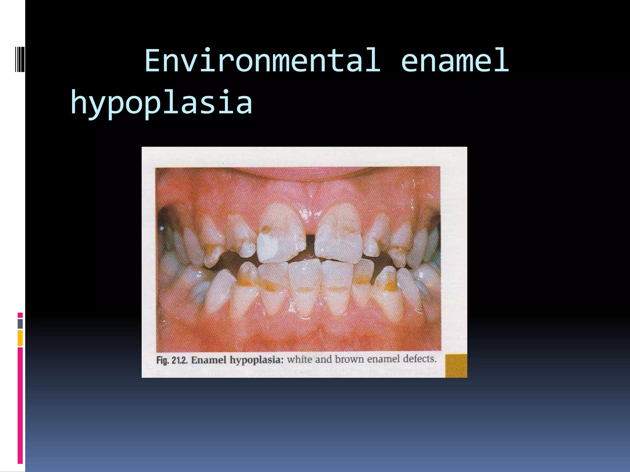 Environmental enamel
hypoplasia
 