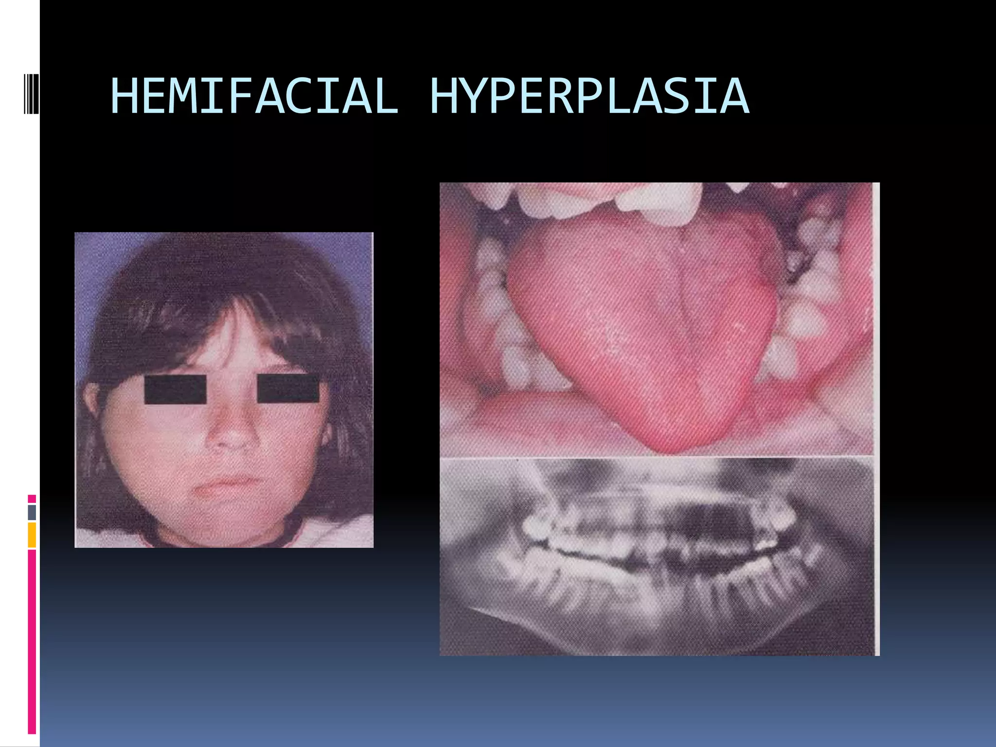 HEMIFACIAL HYPERPLASIA
 