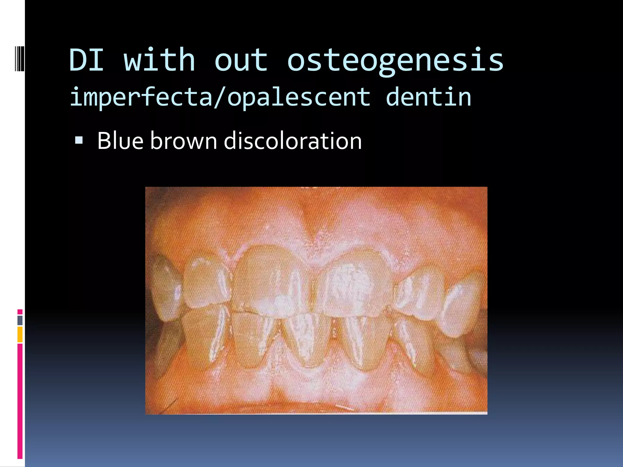 DI with out osteogenesis
imperfecta/opalescent dentin
 Blue brown discoloration
 