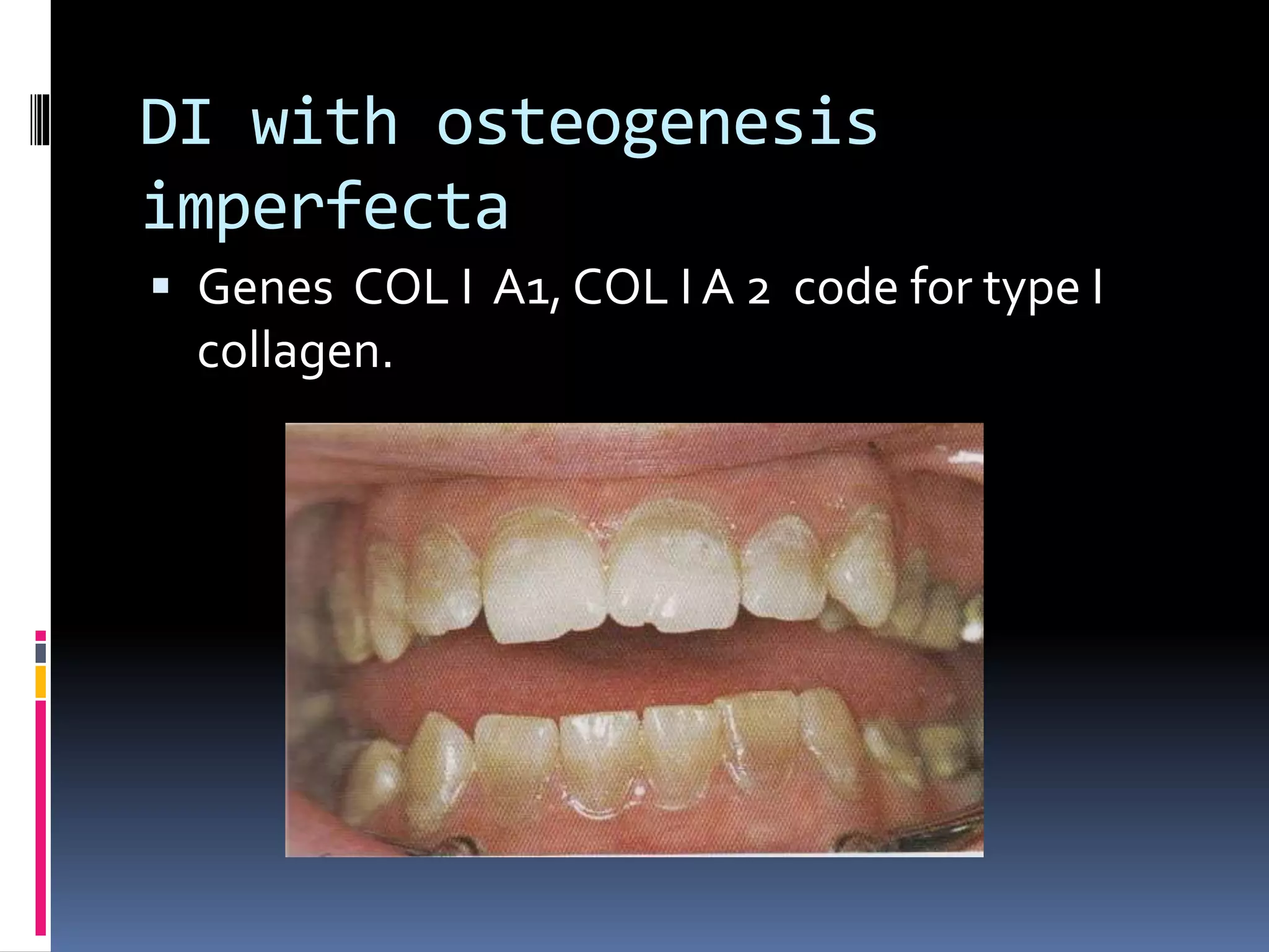 DI with osteogenesis
imperfecta
 Genes COL I A1, COL I A 2 code for type I
collagen.
 