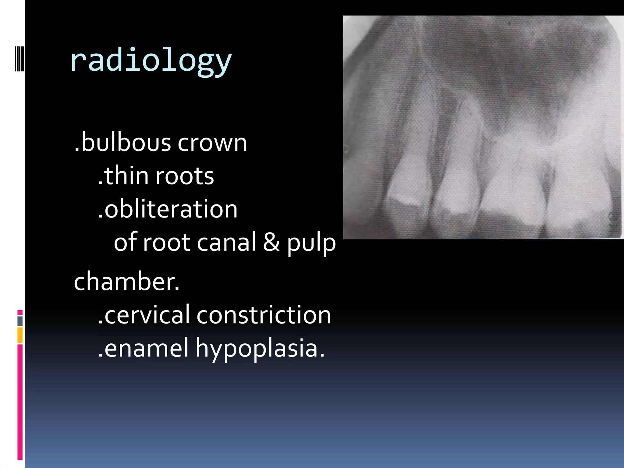 radiology
.bulbous crown
.thin roots
.obliteration
of root canal & pulp
chamber.
.cervical constriction
.enamel hypoplasia.
 