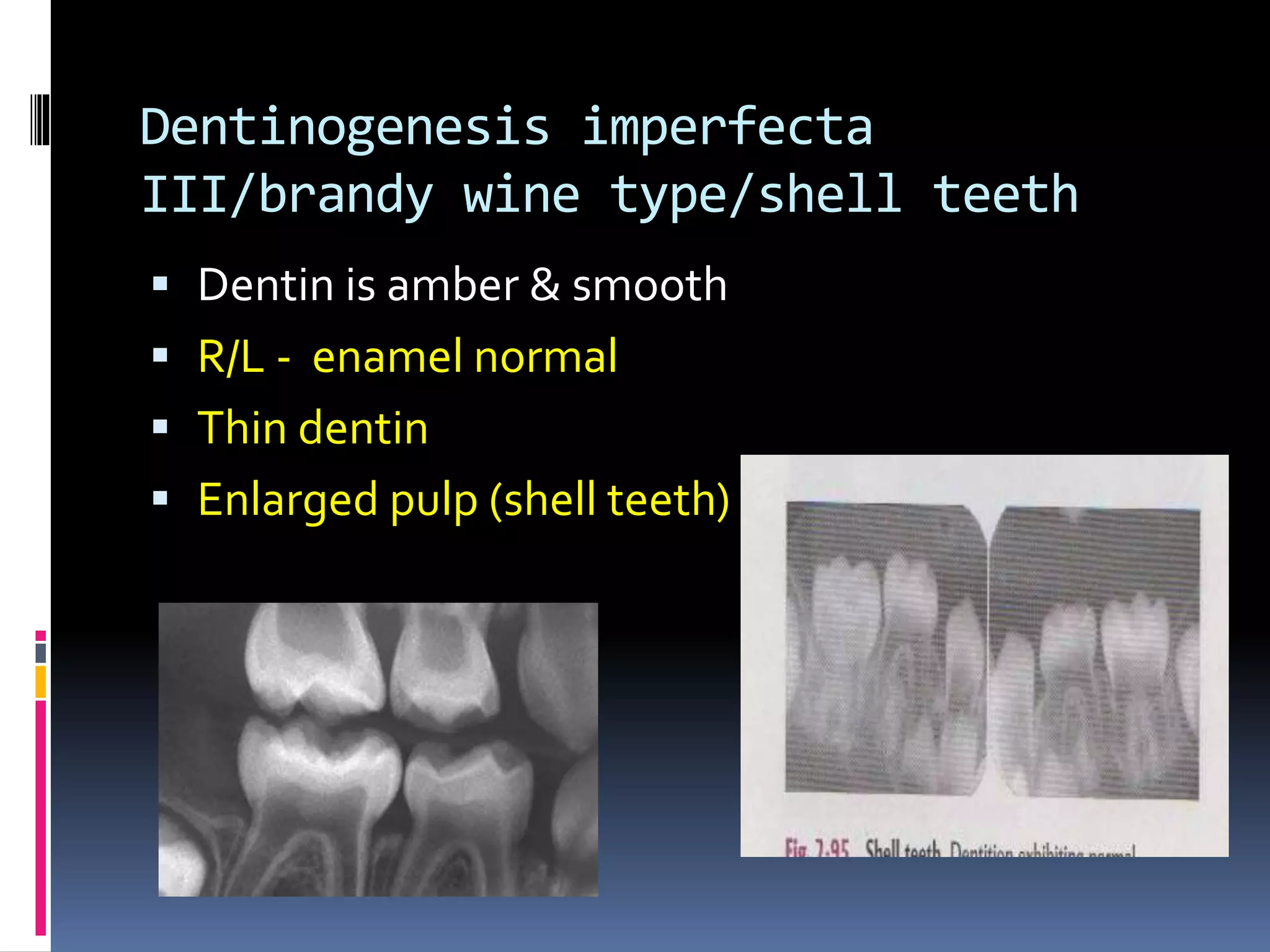 Dentinogenesis imperfecta
III/brandy wine type/shell teeth
 Dentin is amber & smooth
 R/L - enamel normal
 Thin dentin
 Enlarged pulp (shell teeth)
 