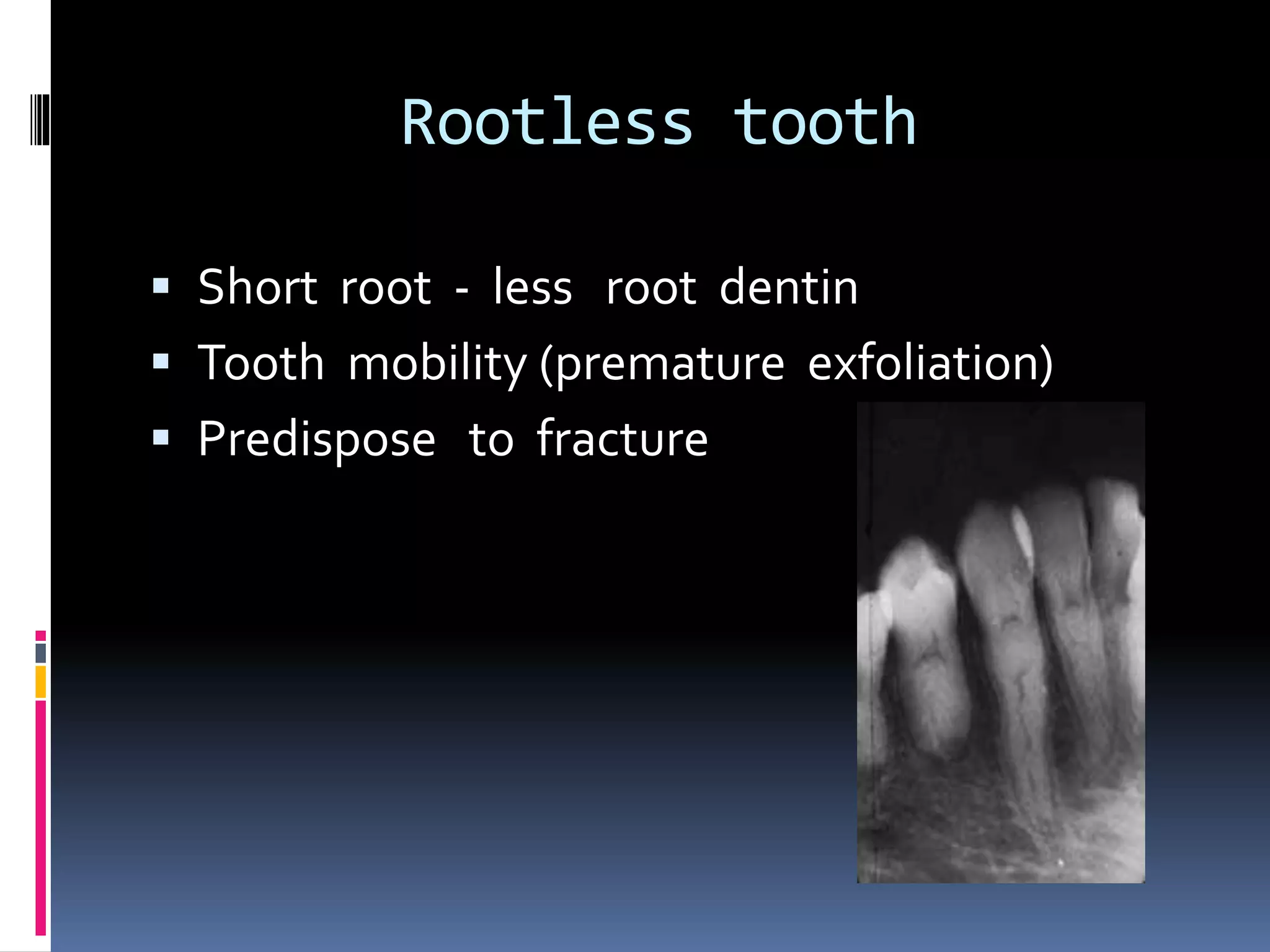 Rootless tooth
 Short root - less root dentin
 Tooth mobility (premature exfoliation)
 Predispose to fracture
 