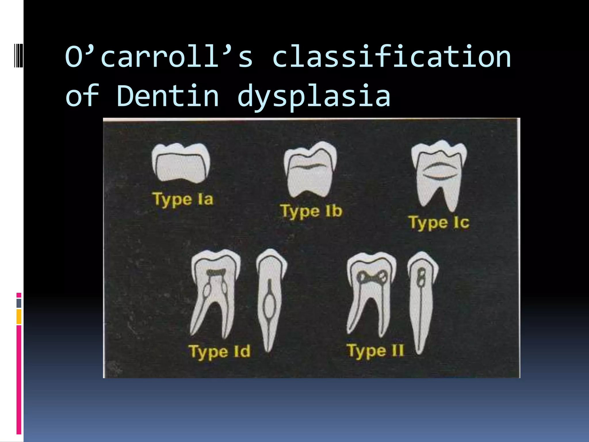 O’carroll’s classification
of Dentin dysplasia
 