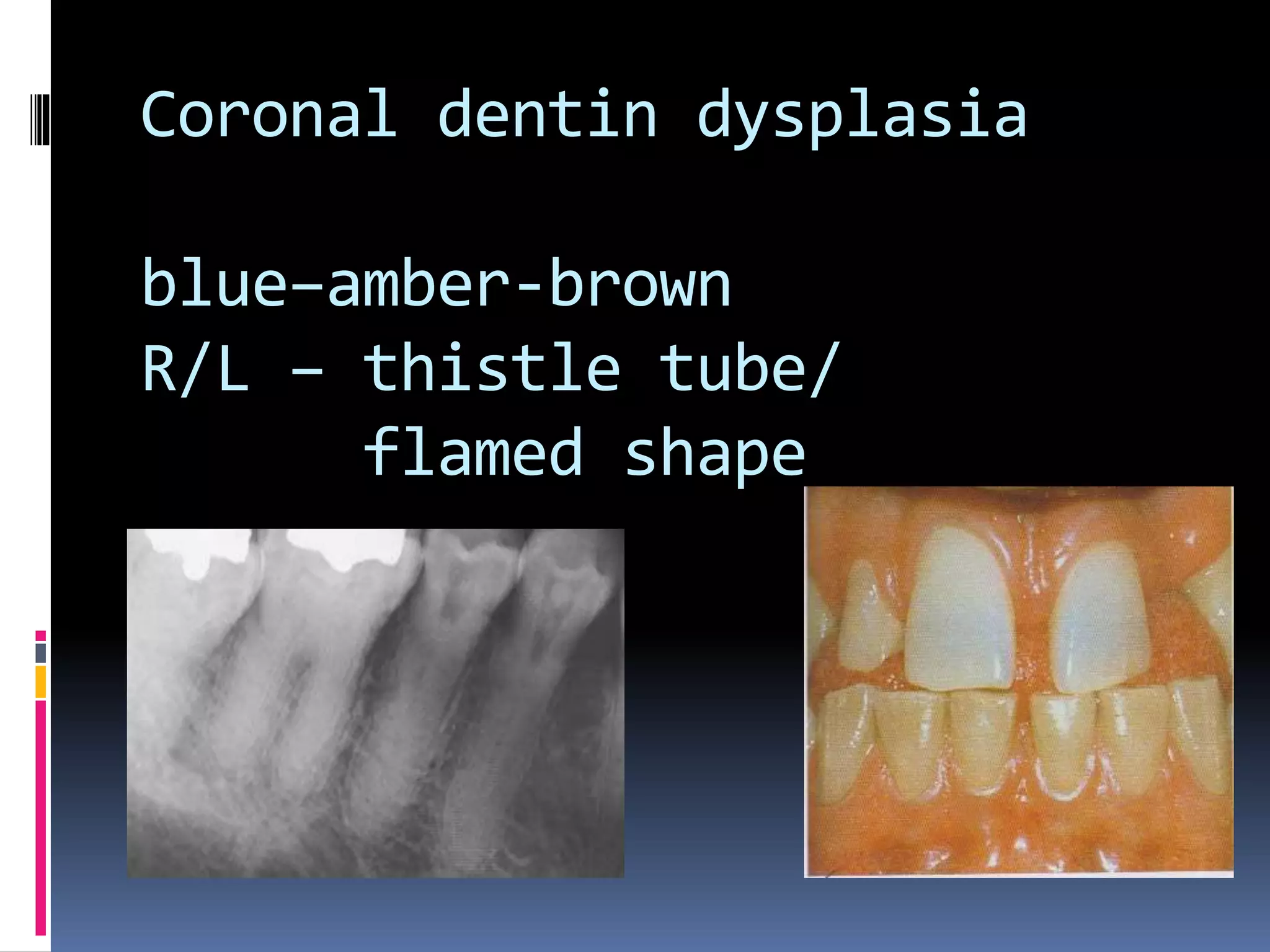 Coronal dentin dysplasia
blue–amber-brown
R/L – thistle tube/
flamed shape
 