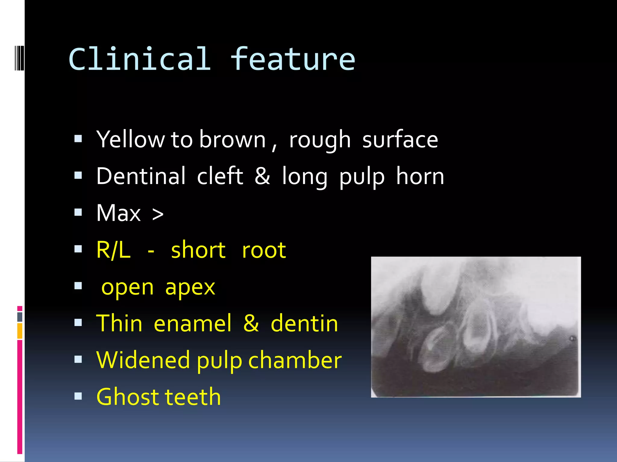 Clinical feature
 Yellow to brown , rough surface
 Dentinal cleft & long pulp horn
 Max >
 R/L - short root
 open apex
 Thin enamel & dentin
 Widened pulp chamber
 Ghost teeth
 
