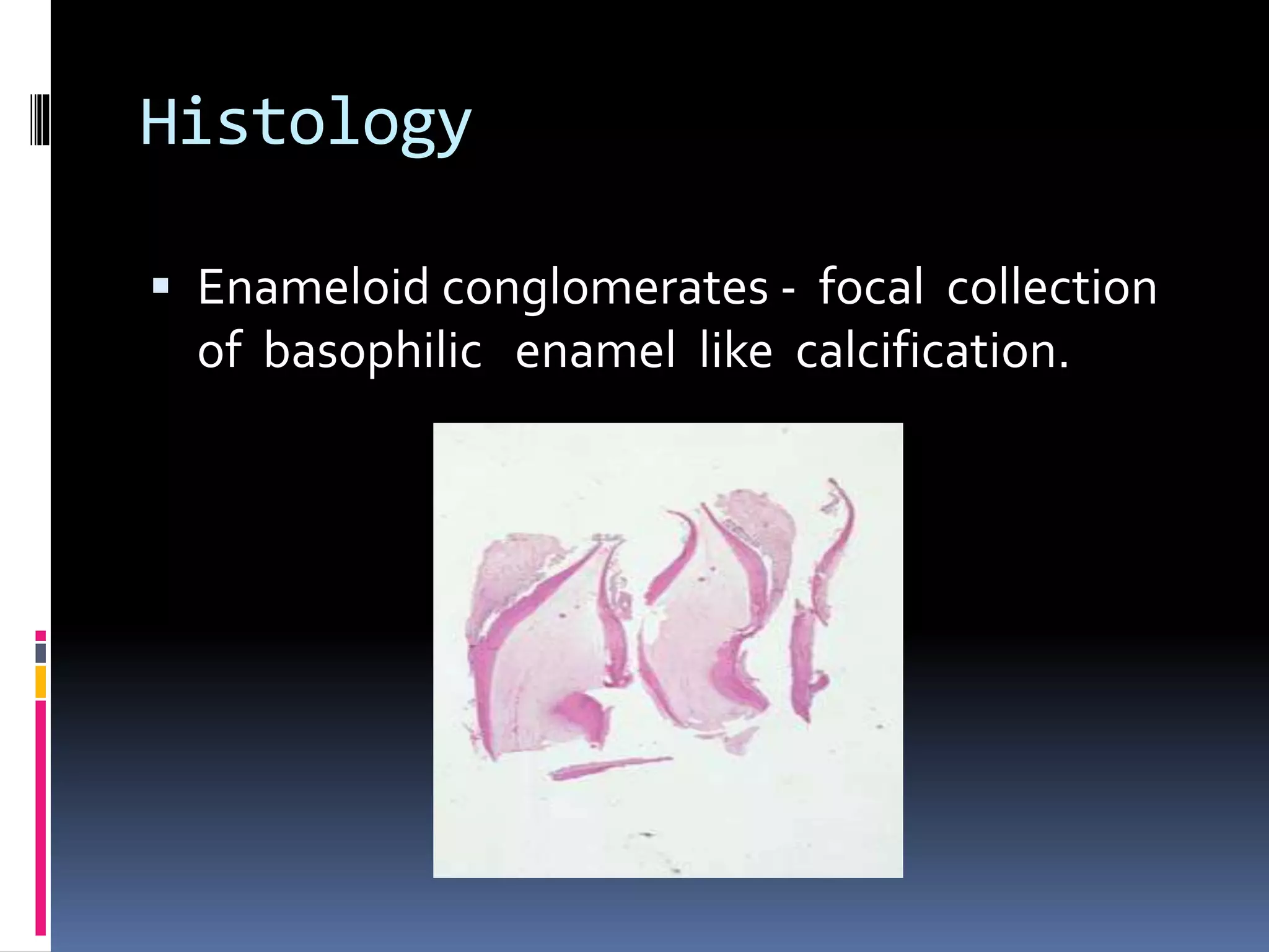 Histology
 Enameloid conglomerates - focal collection
of basophilic enamel like calcification.
 