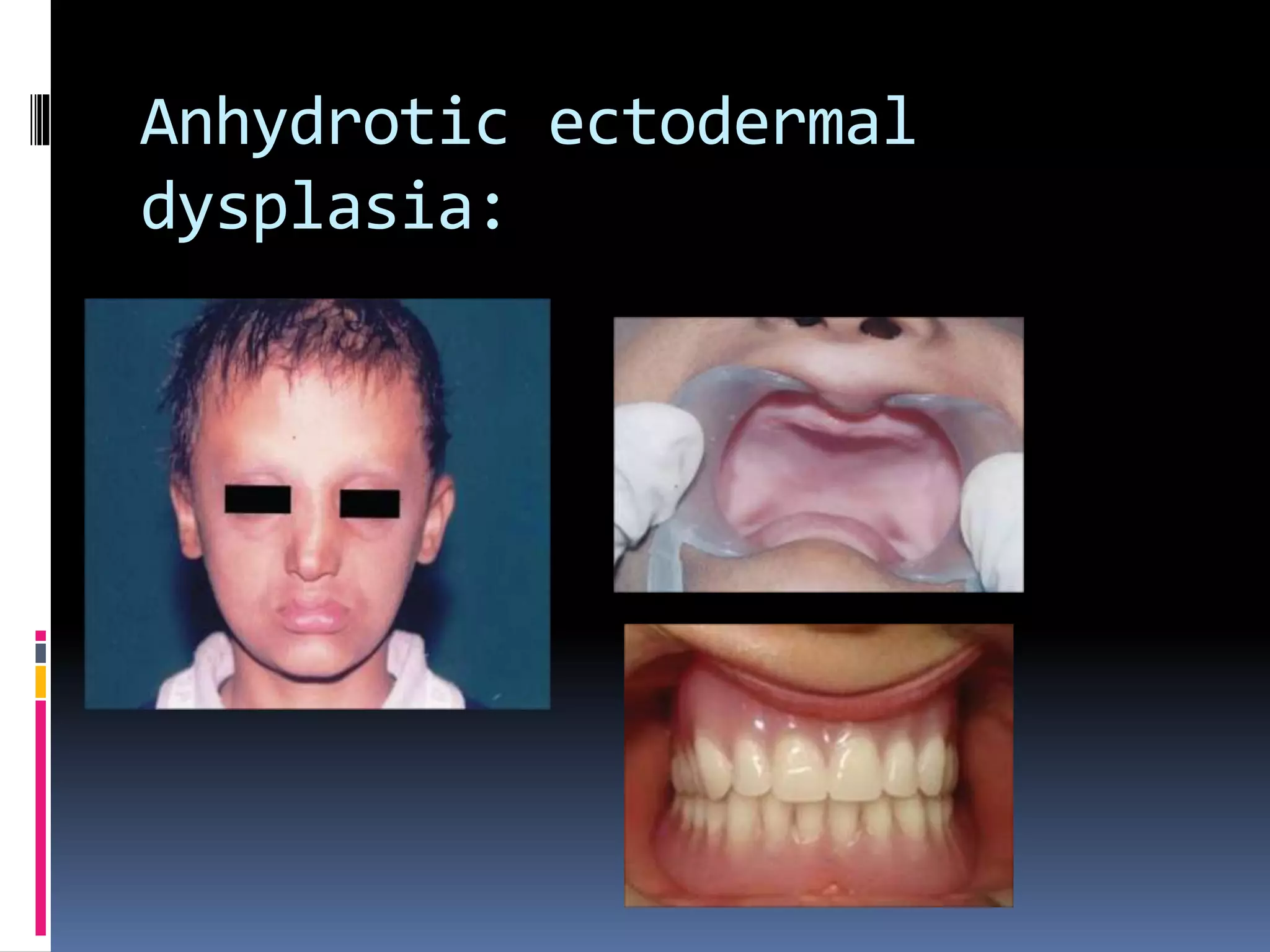 Anhydrotic ectodermal
dysplasia:
 