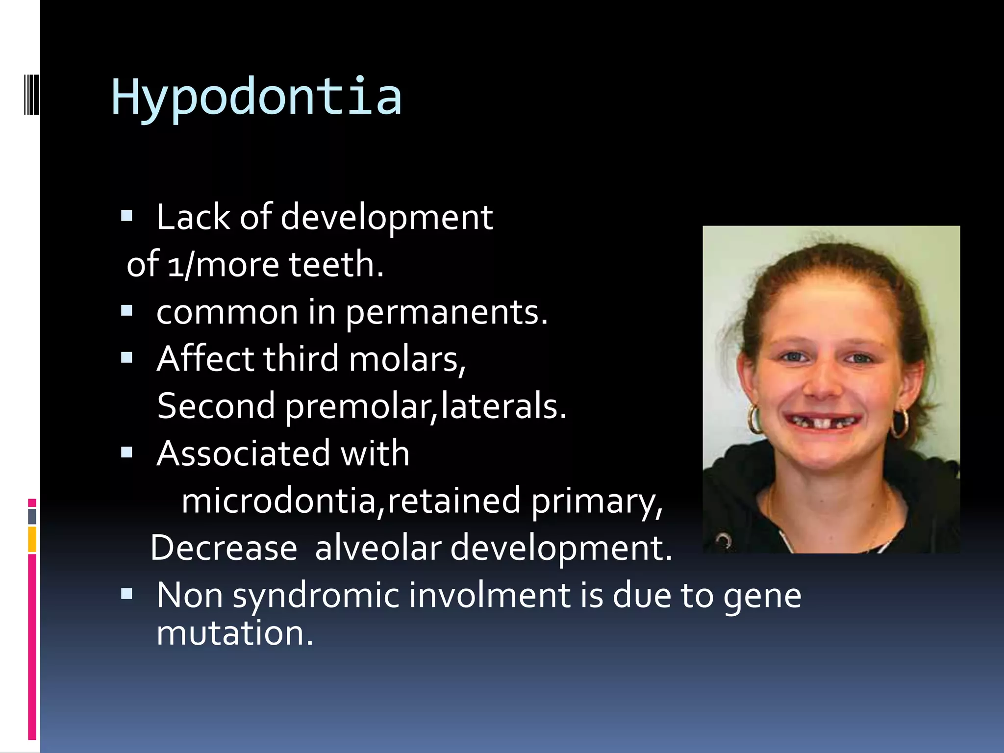 Hypodontia
 Lack of development
of 1/more teeth.
 common in permanents.
 Affect third molars,
Second premolar,laterals.
 Associated with
microdontia,retained primary,
Decrease alveolar development.
 Non syndromic involment is due to gene
mutation.
 