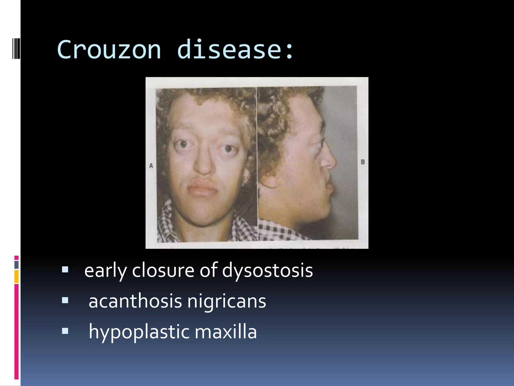 Crouzon disease:
 early closure of dysostosis
 acanthosis nigricans
 hypoplastic maxilla
 