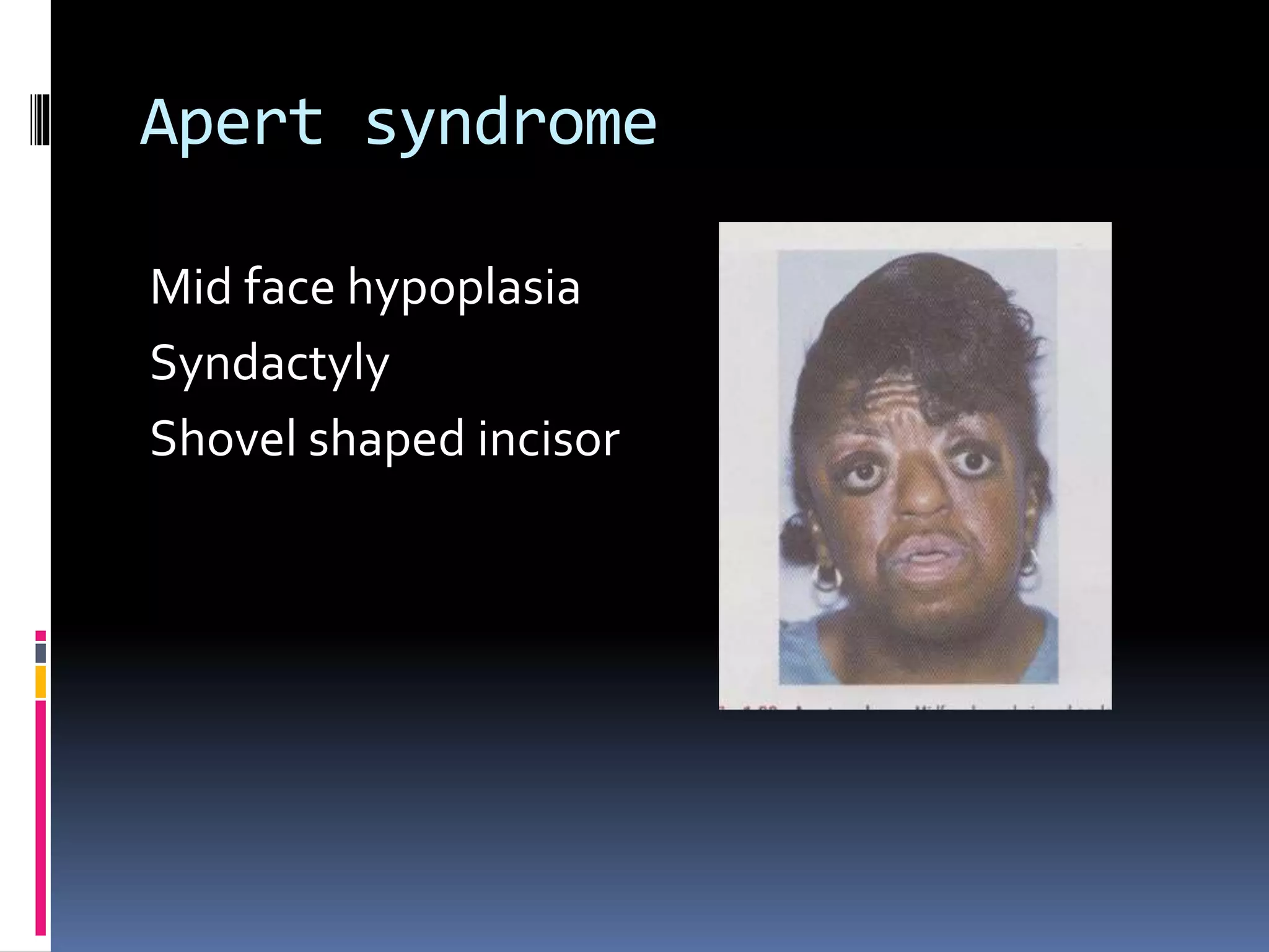 Apert syndrome
Mid face hypoplasia
Syndactyly
Shovel shaped incisor
 