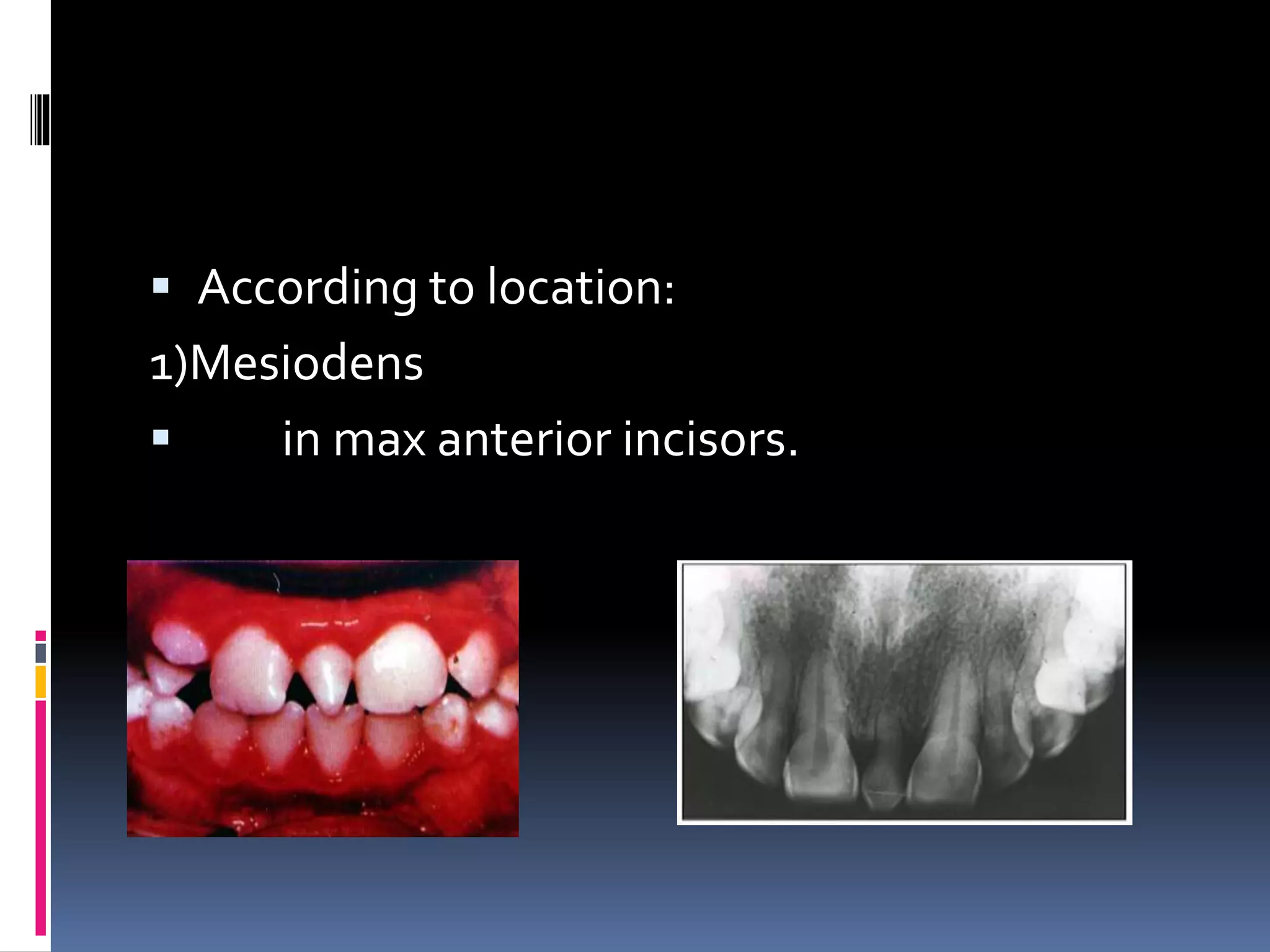  According to location:
1)Mesiodens
 in max anterior incisors.
.
 