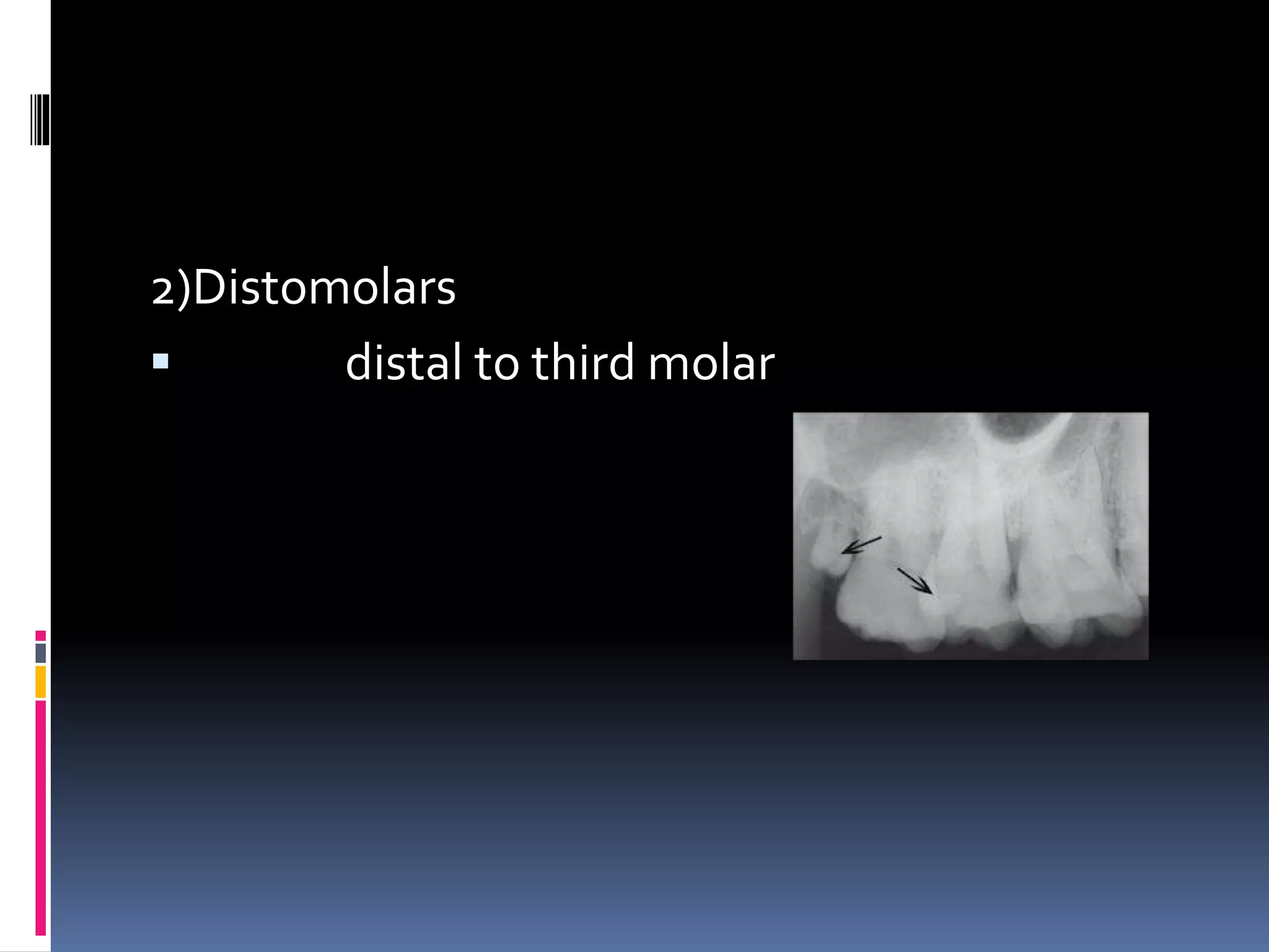 2)Distomolars
 distal to third molar
 