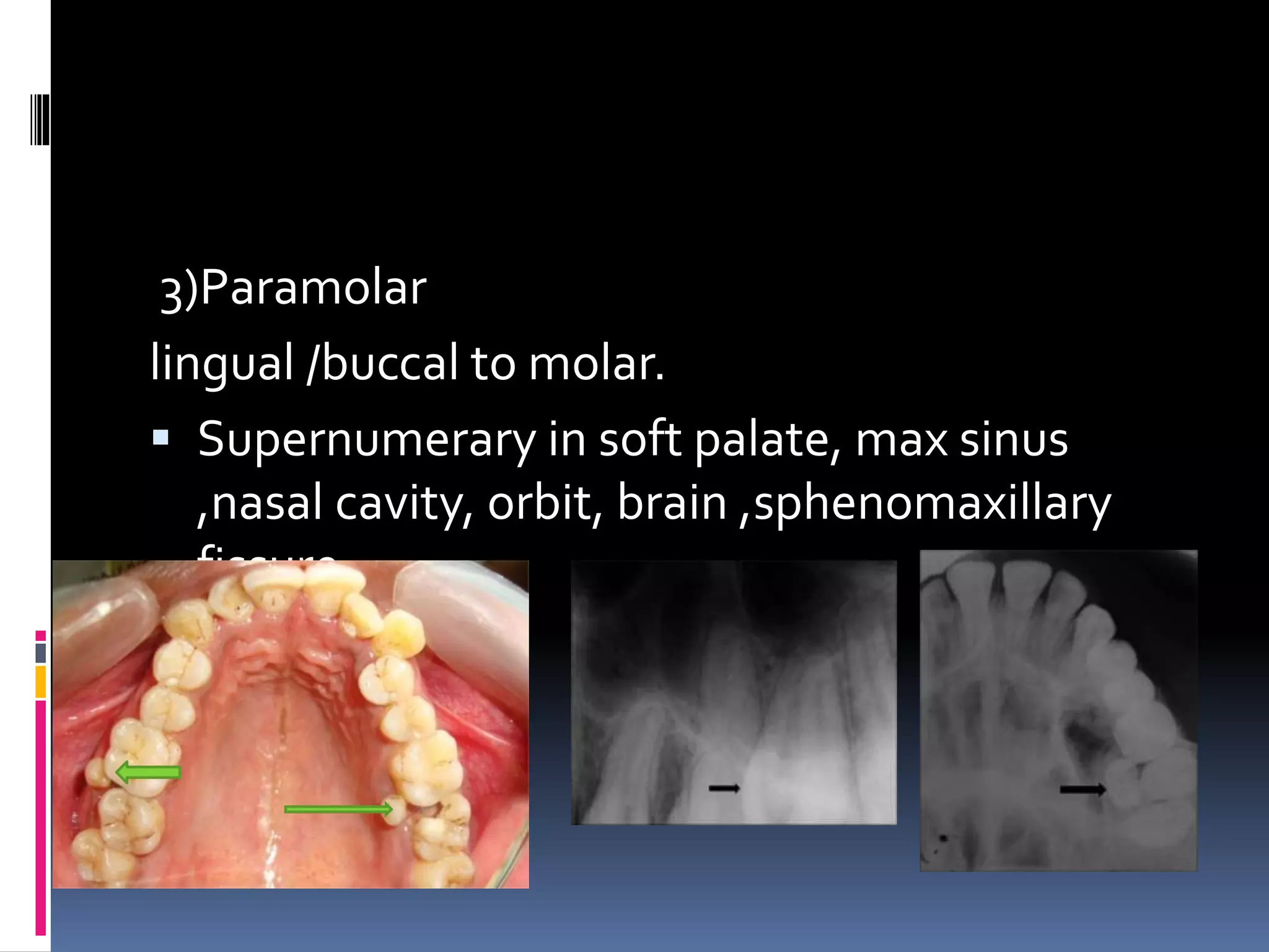 3)Paramolar
lingual /buccal to molar.
 Supernumerary in soft palate, max sinus
,nasal cavity, orbit, brain ,sphenomaxillary
fissure.
 