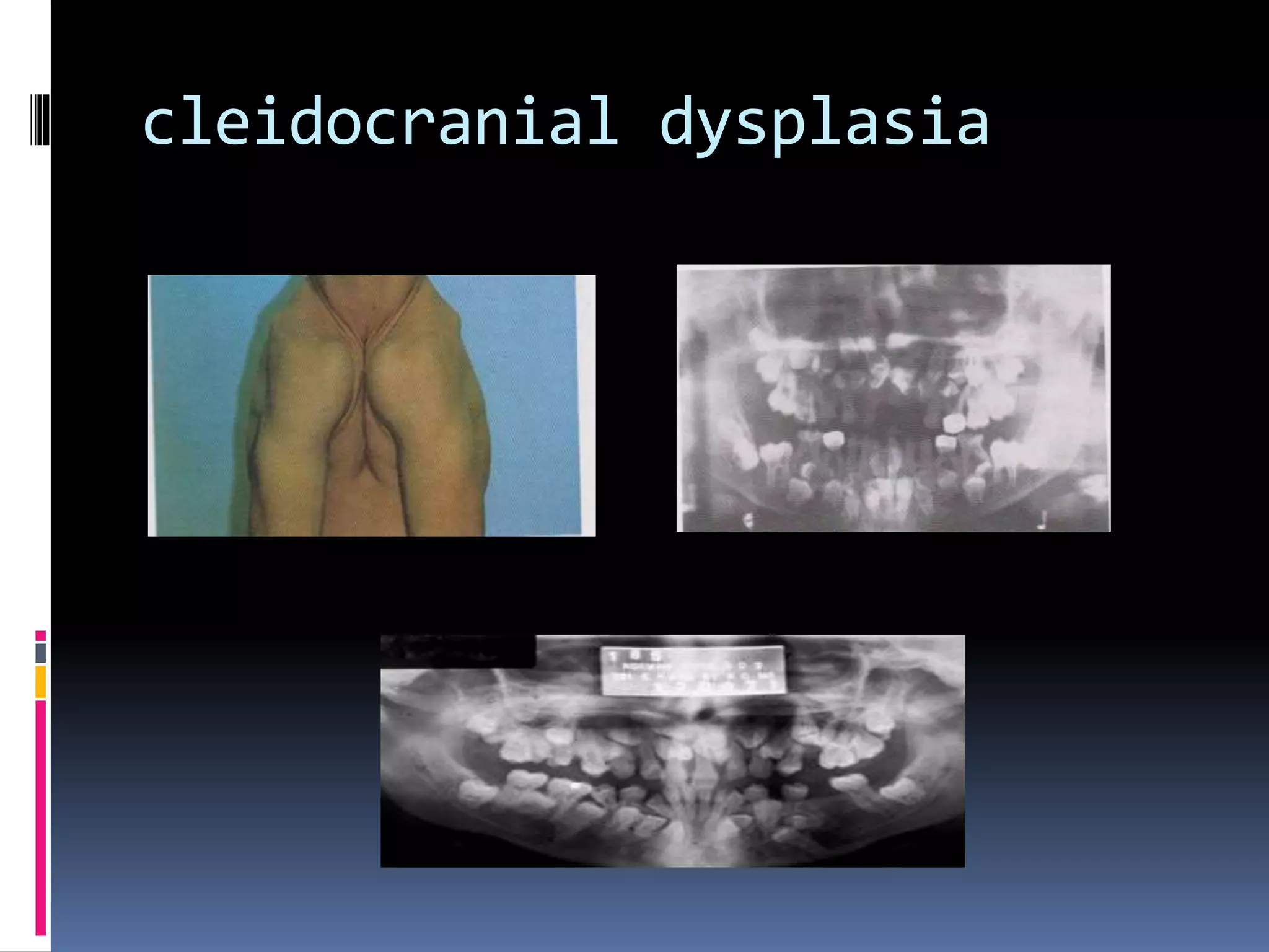 cleidocranial dysplasia
 