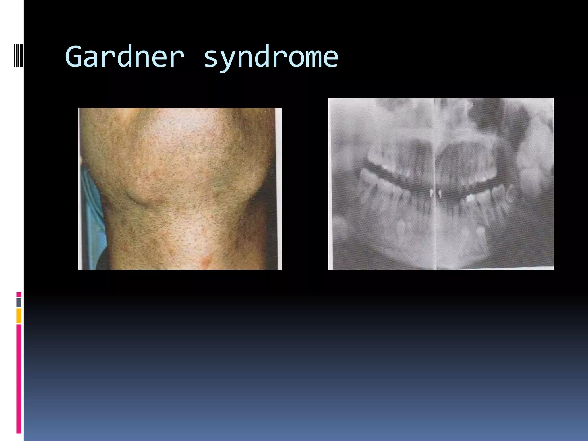Gardner syndrome
 