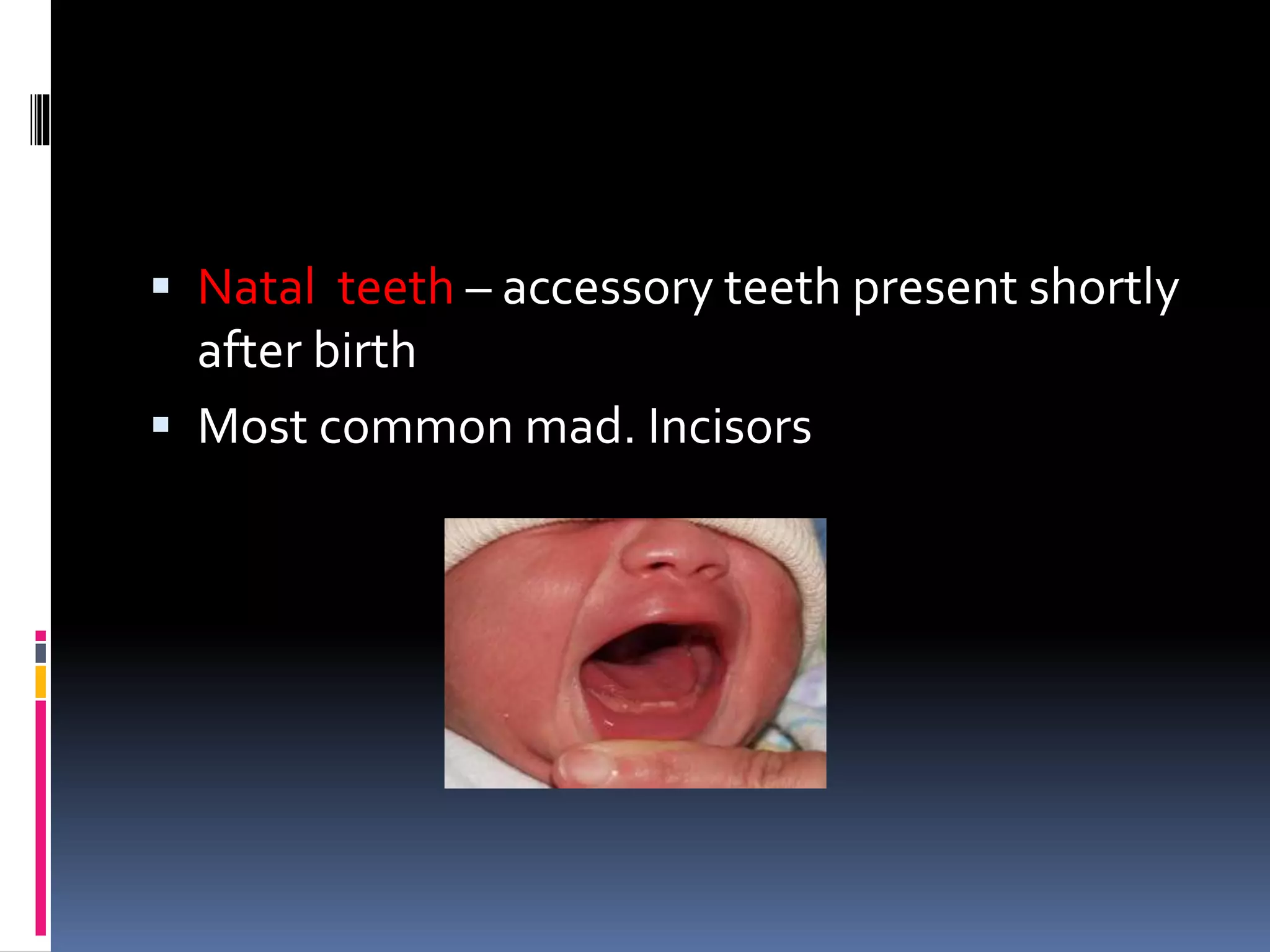  Natal teeth – accessory teeth present shortly
after birth
 Most common mad. Incisors
 