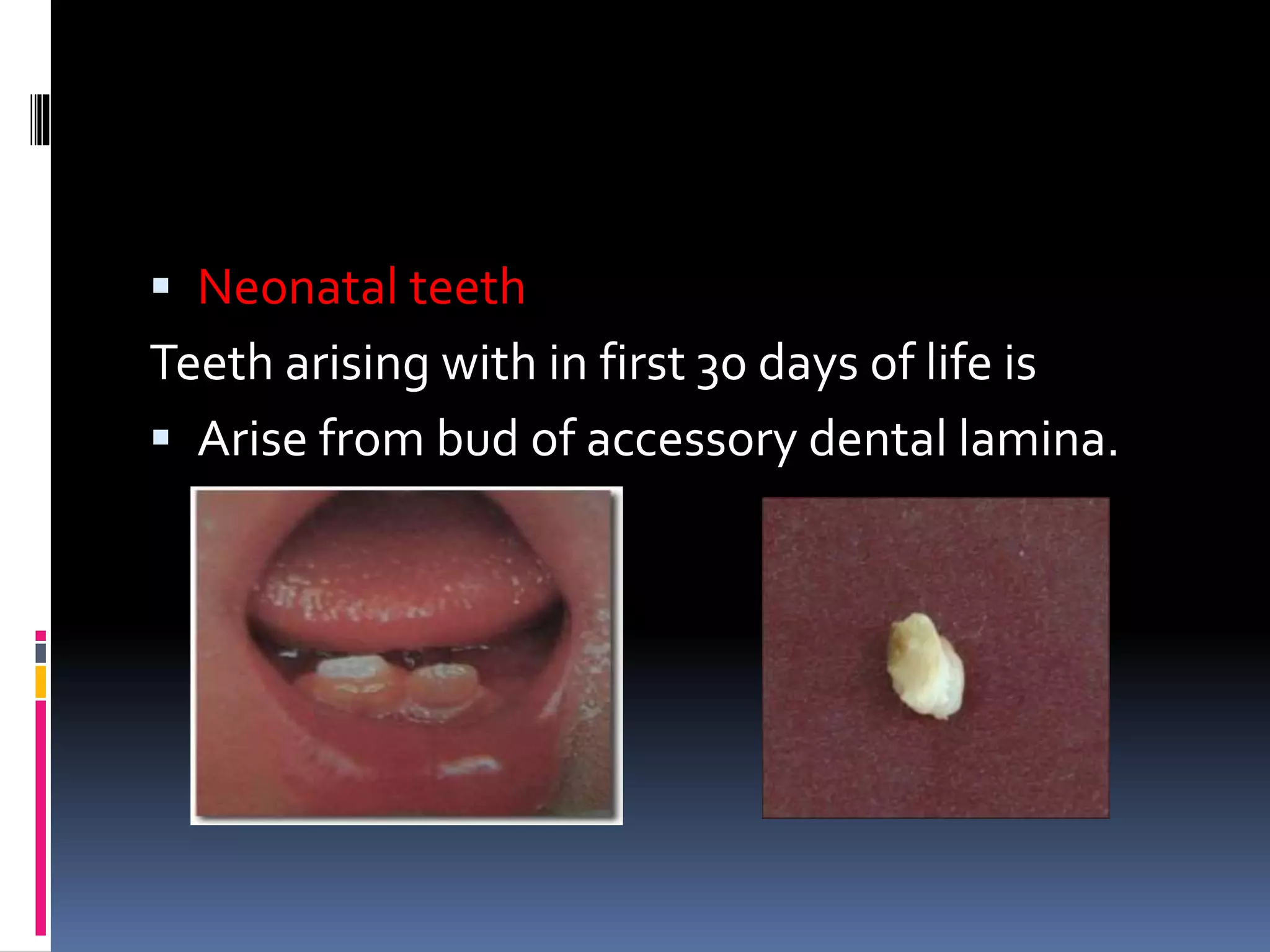  Neonatal teeth
Teeth arising with in first 30 days of life is
 Arise from bud of accessory dental lamina.
 
