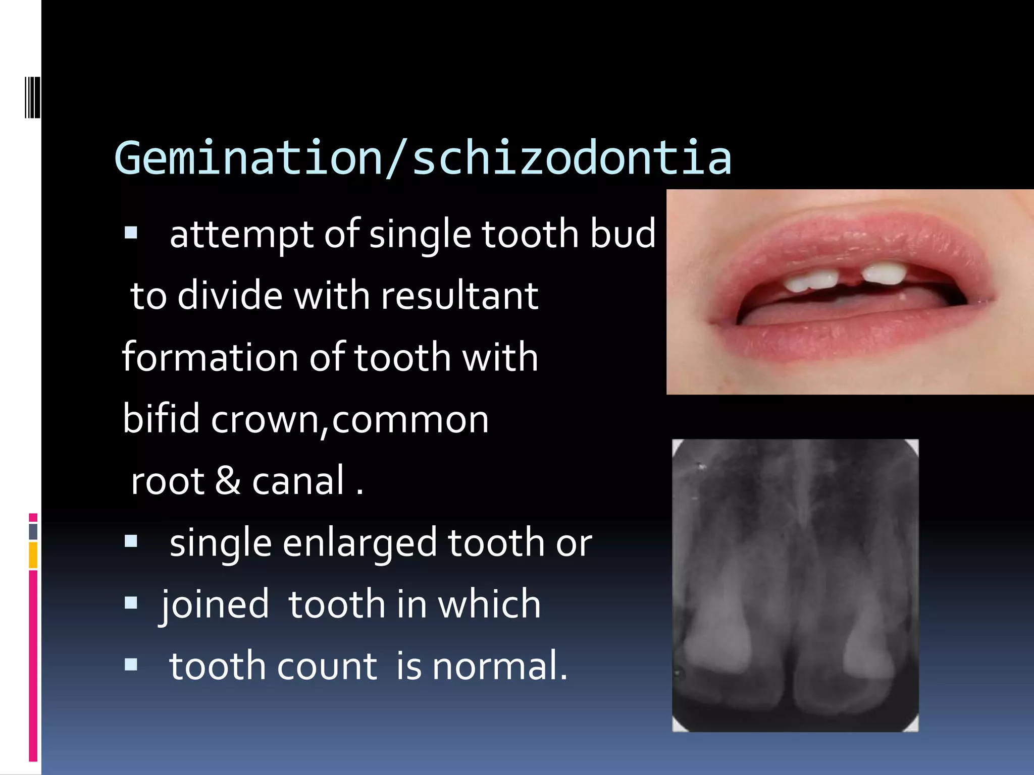 Gemination/schizodontia
 attempt of single tooth bud
to divide with resultant
formation of tooth with
bifid crown,common
root & canal .
 single enlarged tooth or
 joined tooth in which
 tooth count is normal.
 