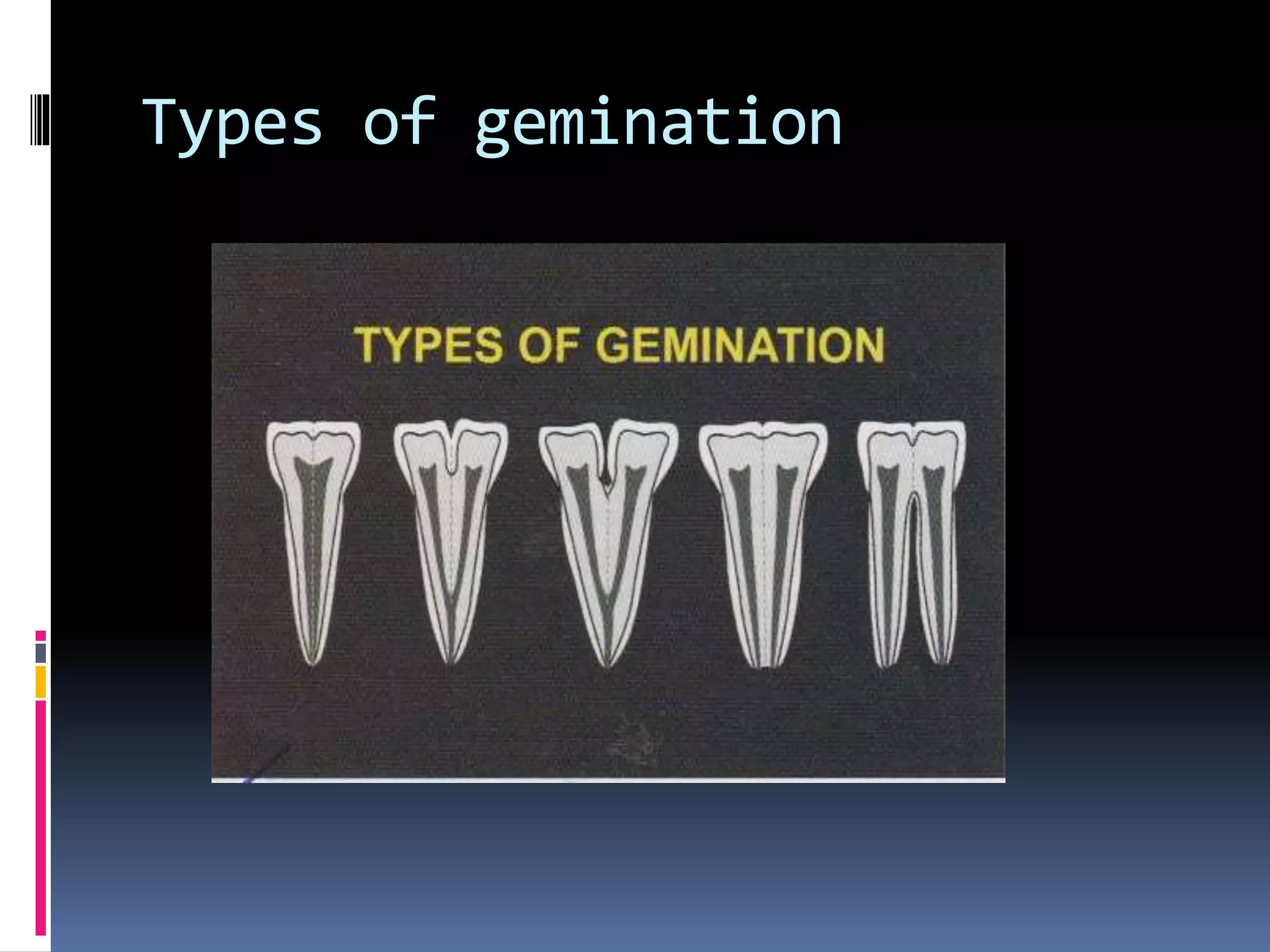 Types of gemination
 