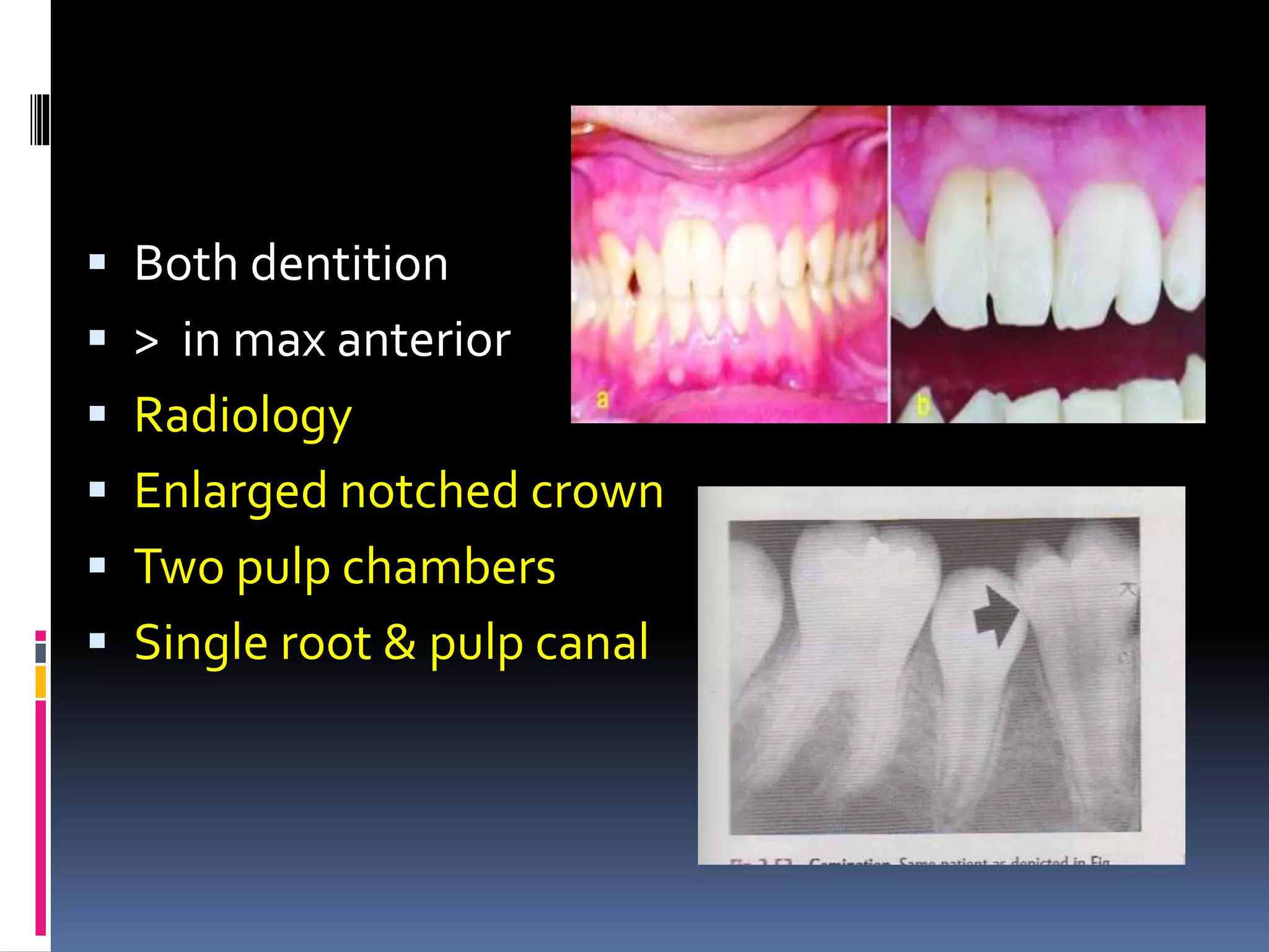  Both dentition
 > in max anterior
 Radiology
 Enlarged notched crown
 Two pulp chambers
 Single root & pulp canal
 
