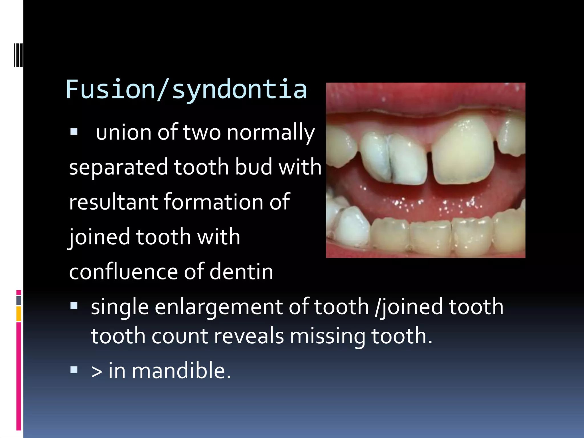 Fusion/syndontia
 union of two normally
separated tooth bud with
resultant formation of
joined tooth with
confluence of dentin
 single enlargement of tooth /joined tooth
tooth count reveals missing tooth.
 > in mandible.
 