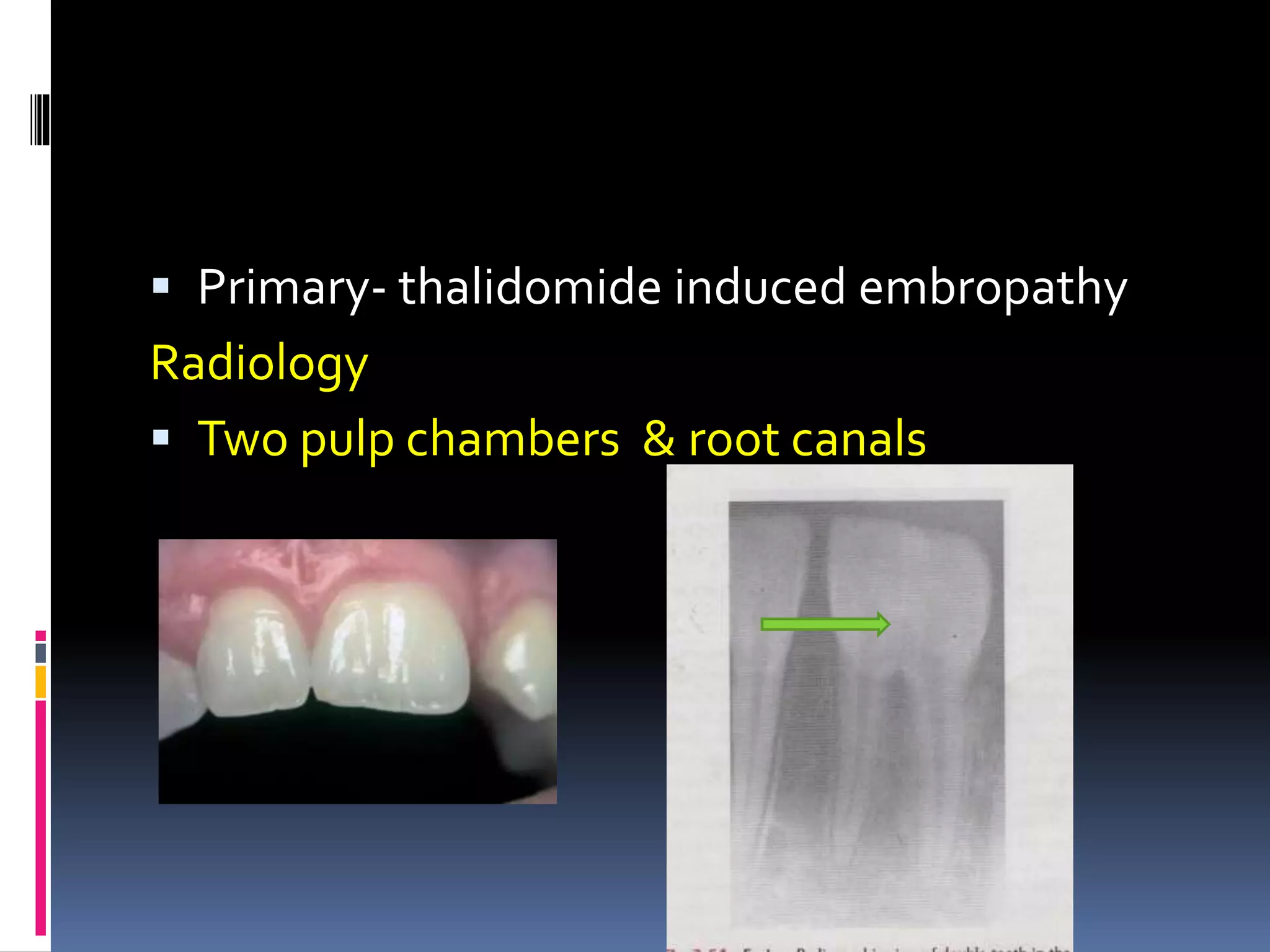  Primary- thalidomide induced embropathy
Radiology
 Two pulp chambers & root canals
 