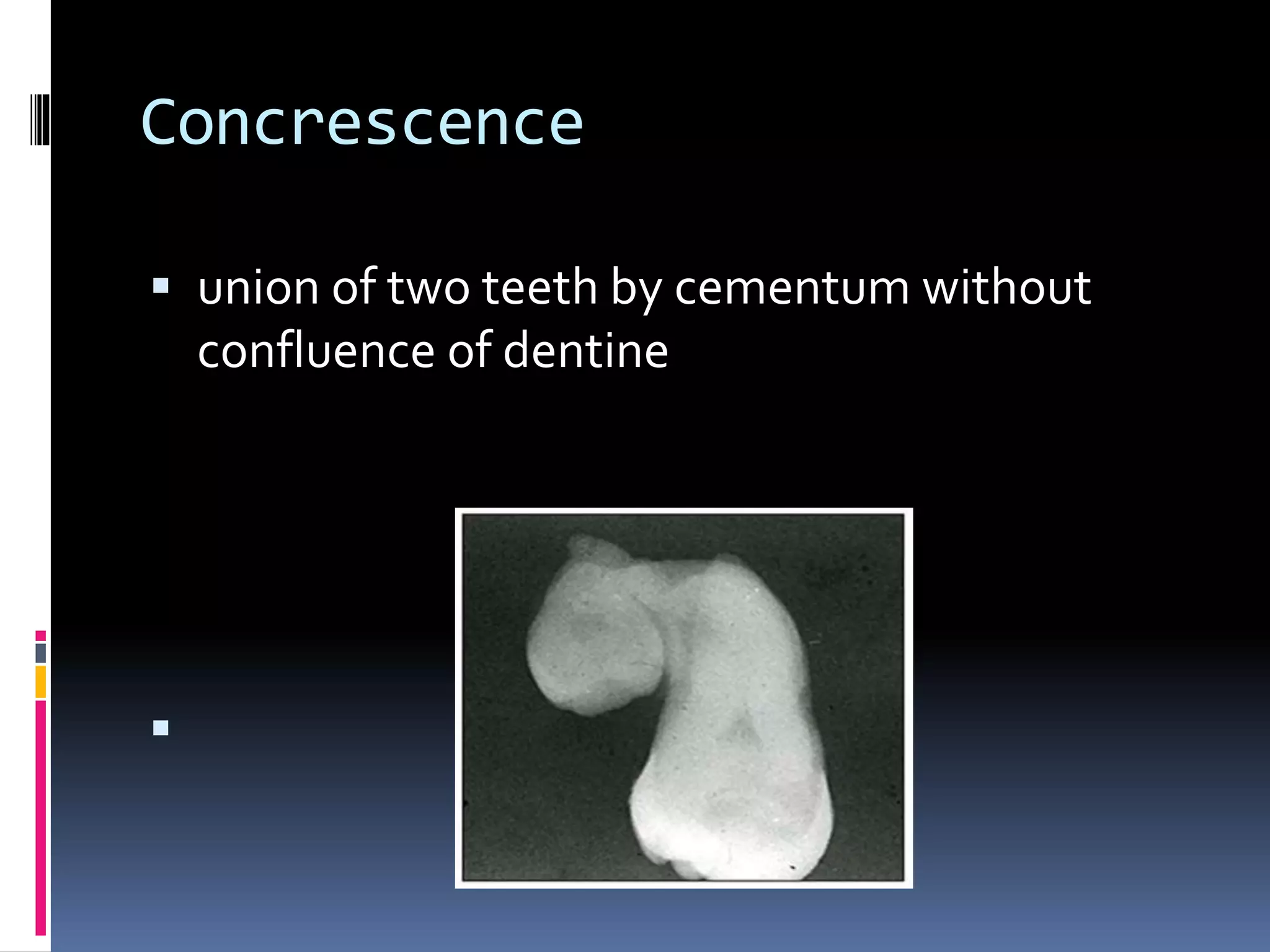 Concrescence
 union of two teeth by cementum without
confluence of dentine

 