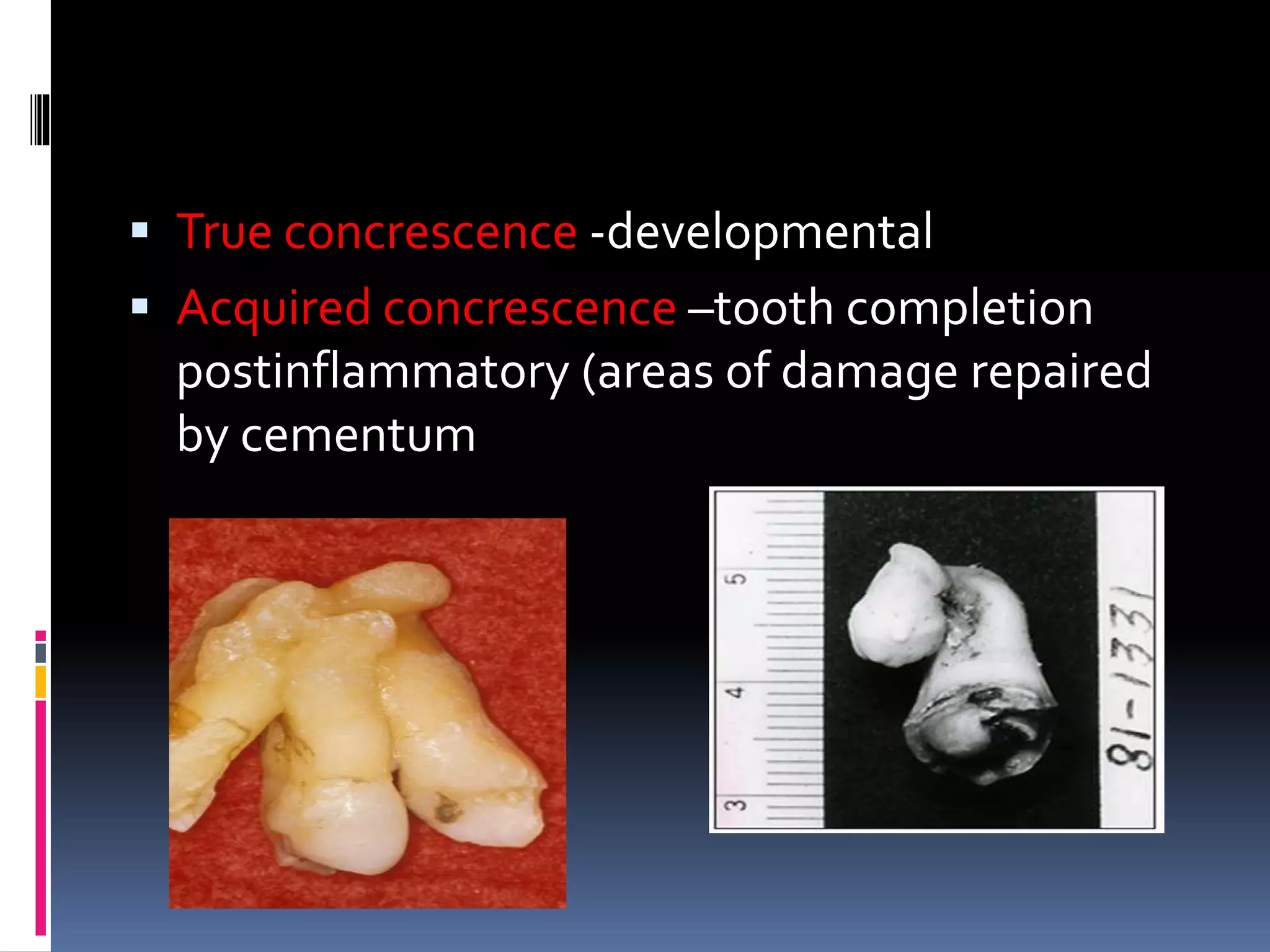  True concrescence -developmental
 Acquired concrescence –tooth completion
postinflammatory (areas of damage repaired
by cementum
 