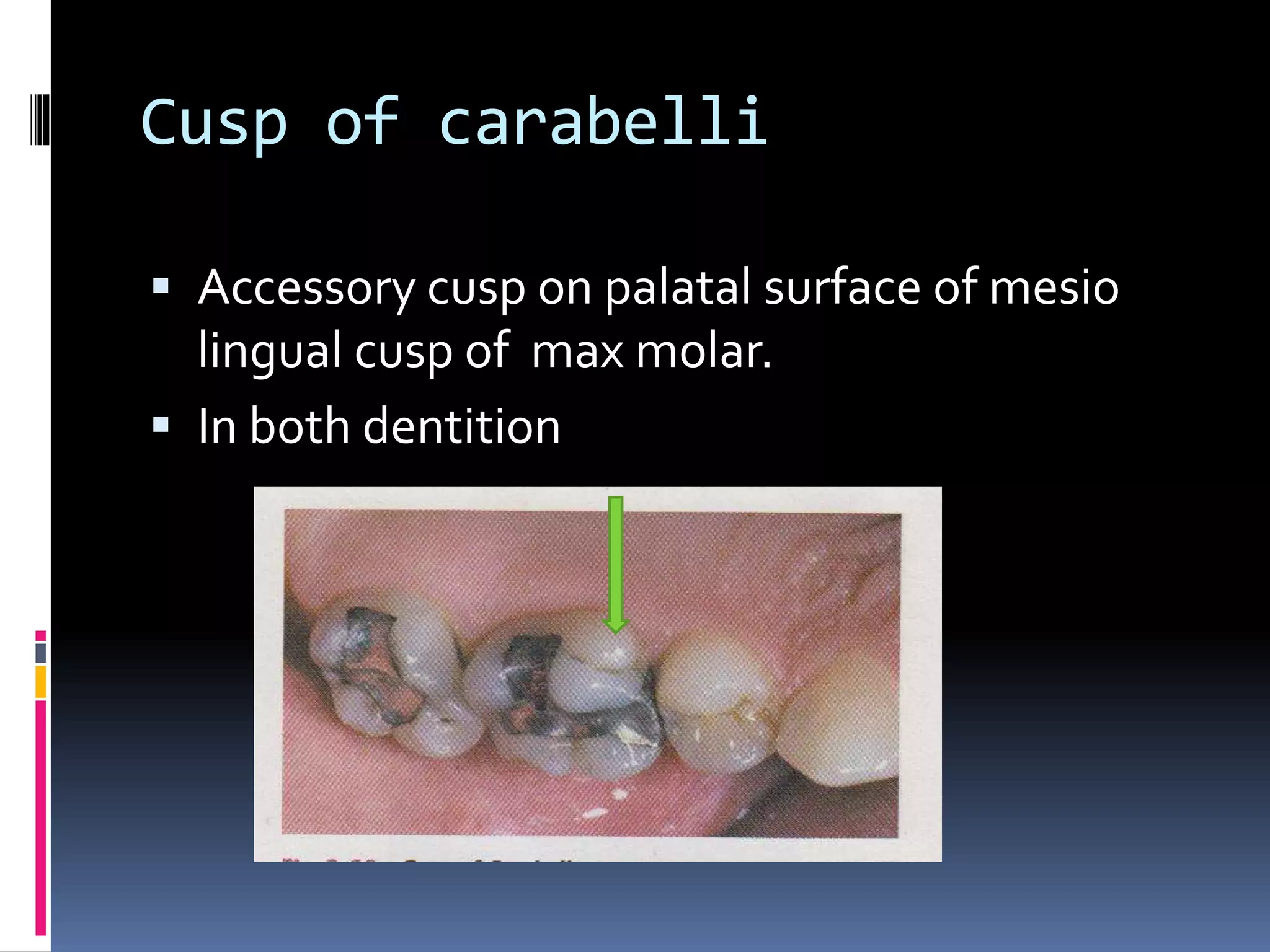 Cusp of carabelli
 Accessory cusp on palatal surface of mesio
lingual cusp of max molar.
 In both dentition
 