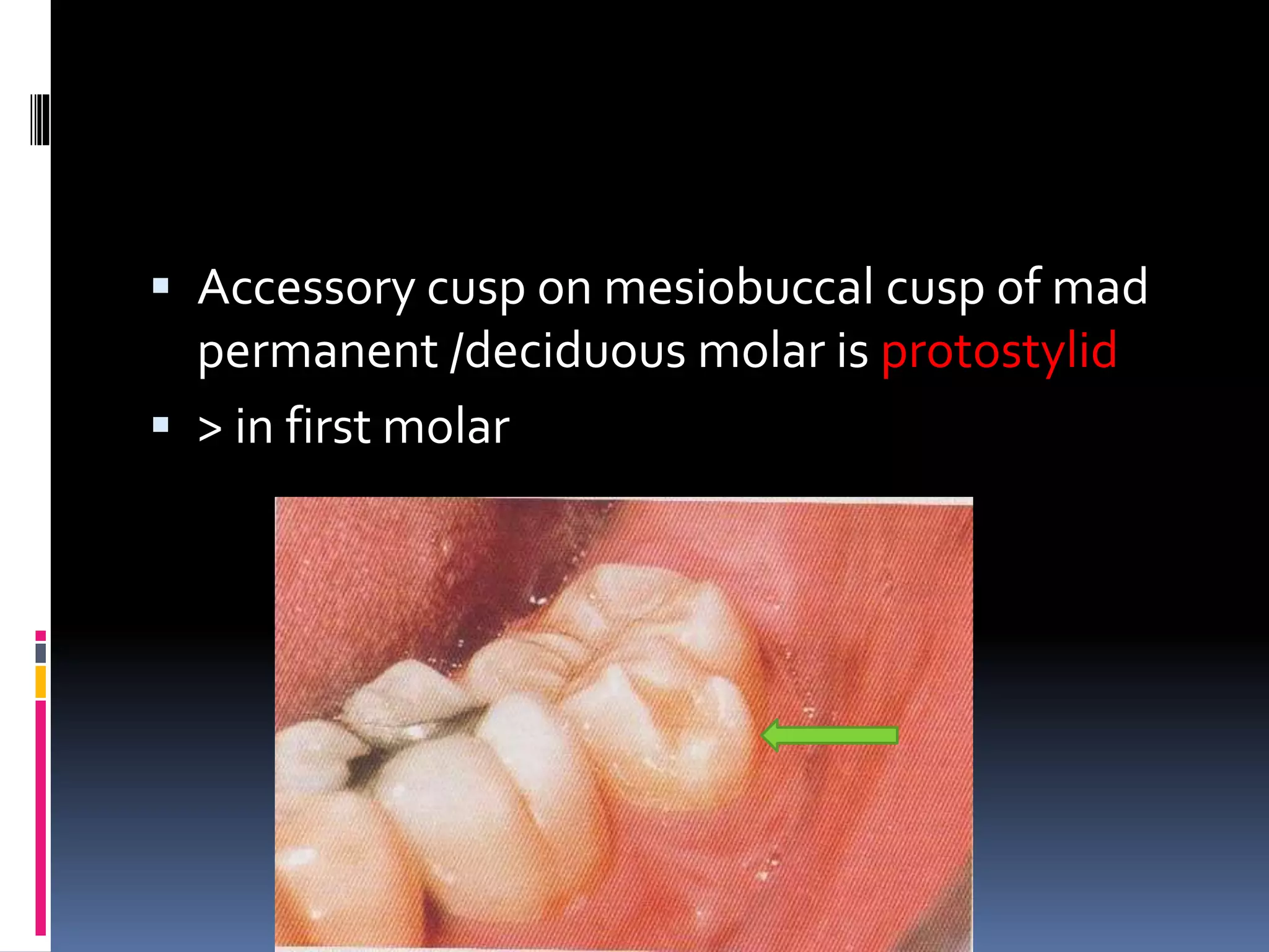  Accessory cusp on mesiobuccal cusp of mad
permanent /deciduous molar is protostylid
 > in first molar
 