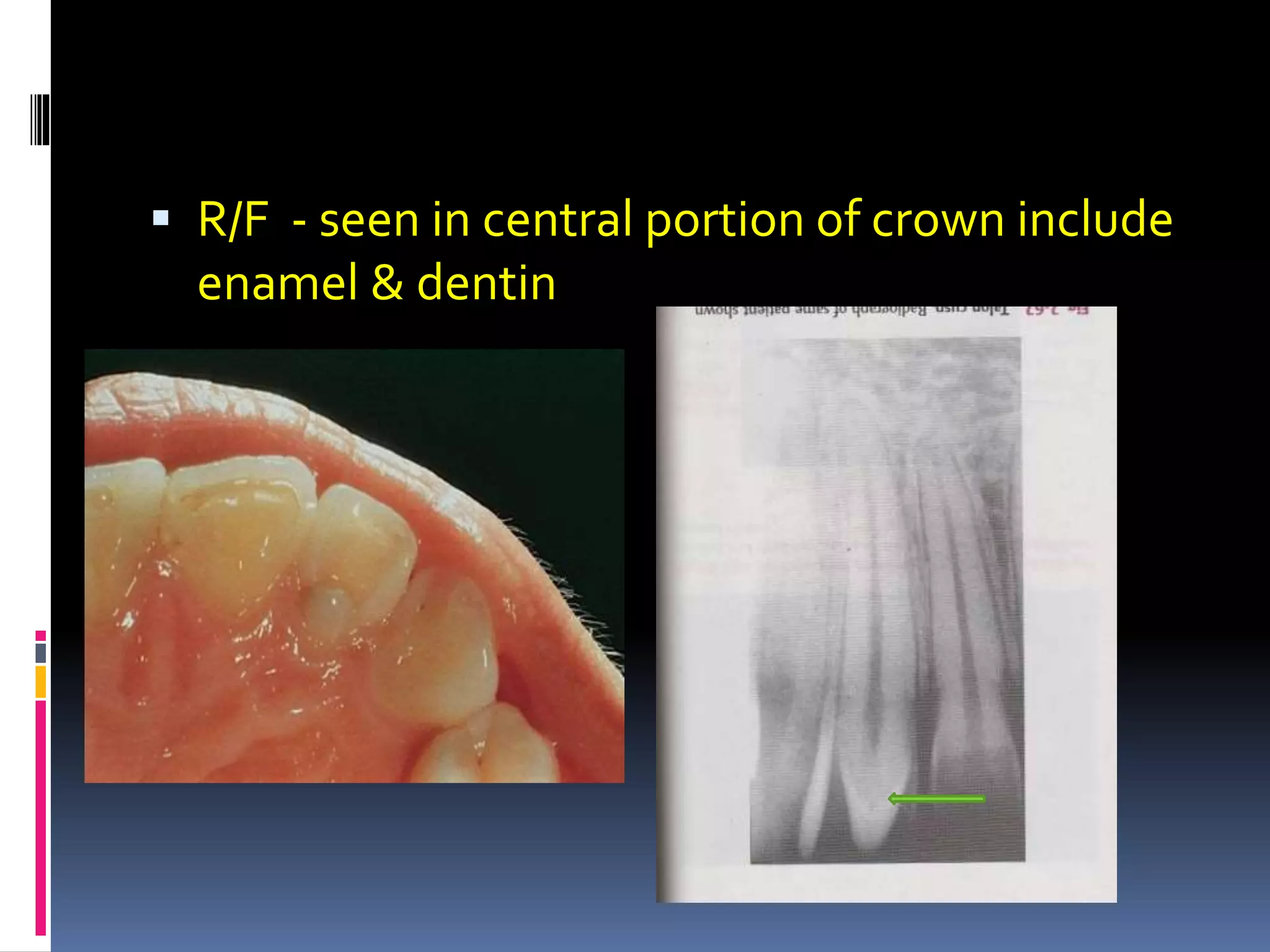  R/F - seen in central portion of crown include
enamel & dentin
 