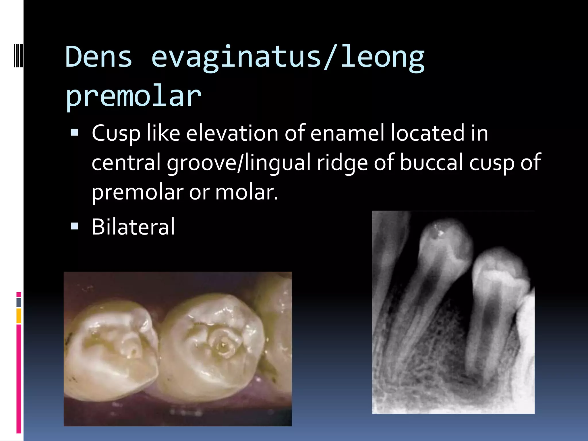 Dens evaginatus/leong
premolar
 Cusp like elevation of enamel located in
central groove/lingual ridge of buccal cusp of
premolar or molar.
 Bilateral
 