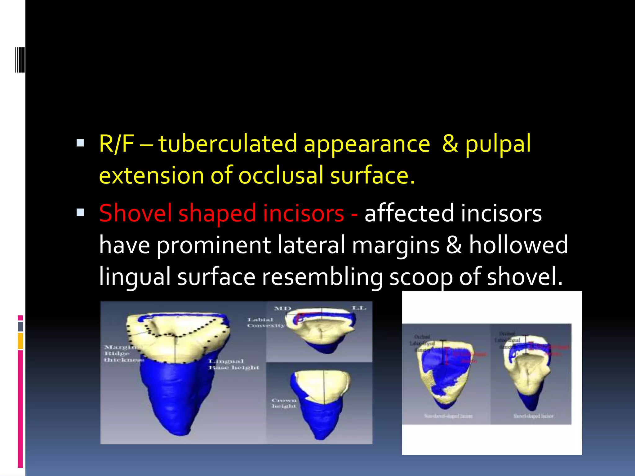  R/F – tuberculated appearance & pulpal
extension of occlusal surface.
 Shovel shaped incisors - affected incisors
have prominent lateral margins & hollowed
lingual surface resembling scoop of shovel.
 