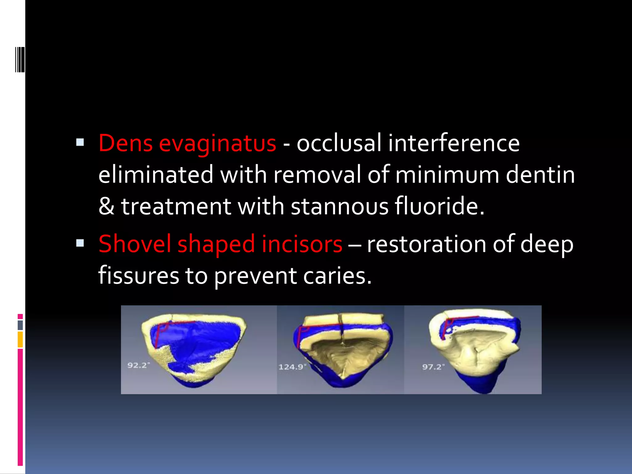  Dens evaginatus - occlusal interference
eliminated with removal of minimum dentin
& treatment with stannous fluoride.
 Shovel shaped incisors – restoration of deep
fissures to prevent caries.
 