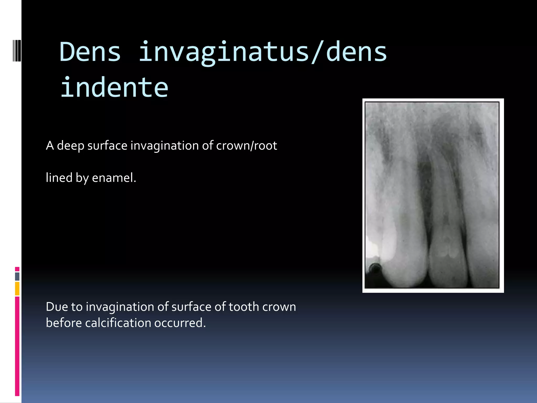Dens invaginatus/dens
indente
A deep surface invagination of crown/root
lined by enamel.
Due to invagination of surface of tooth crown
before calcification occurred.
 