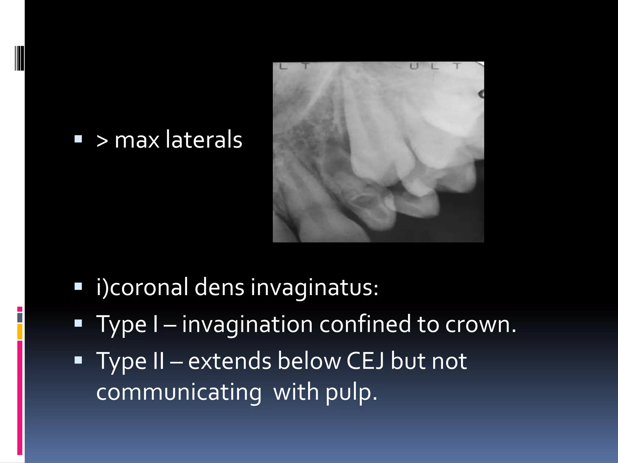  > max laterals
 i)coronal dens invaginatus:
 Type I – invagination confined to crown.
 Type II – extends below CEJ but not
communicating with pulp.
 