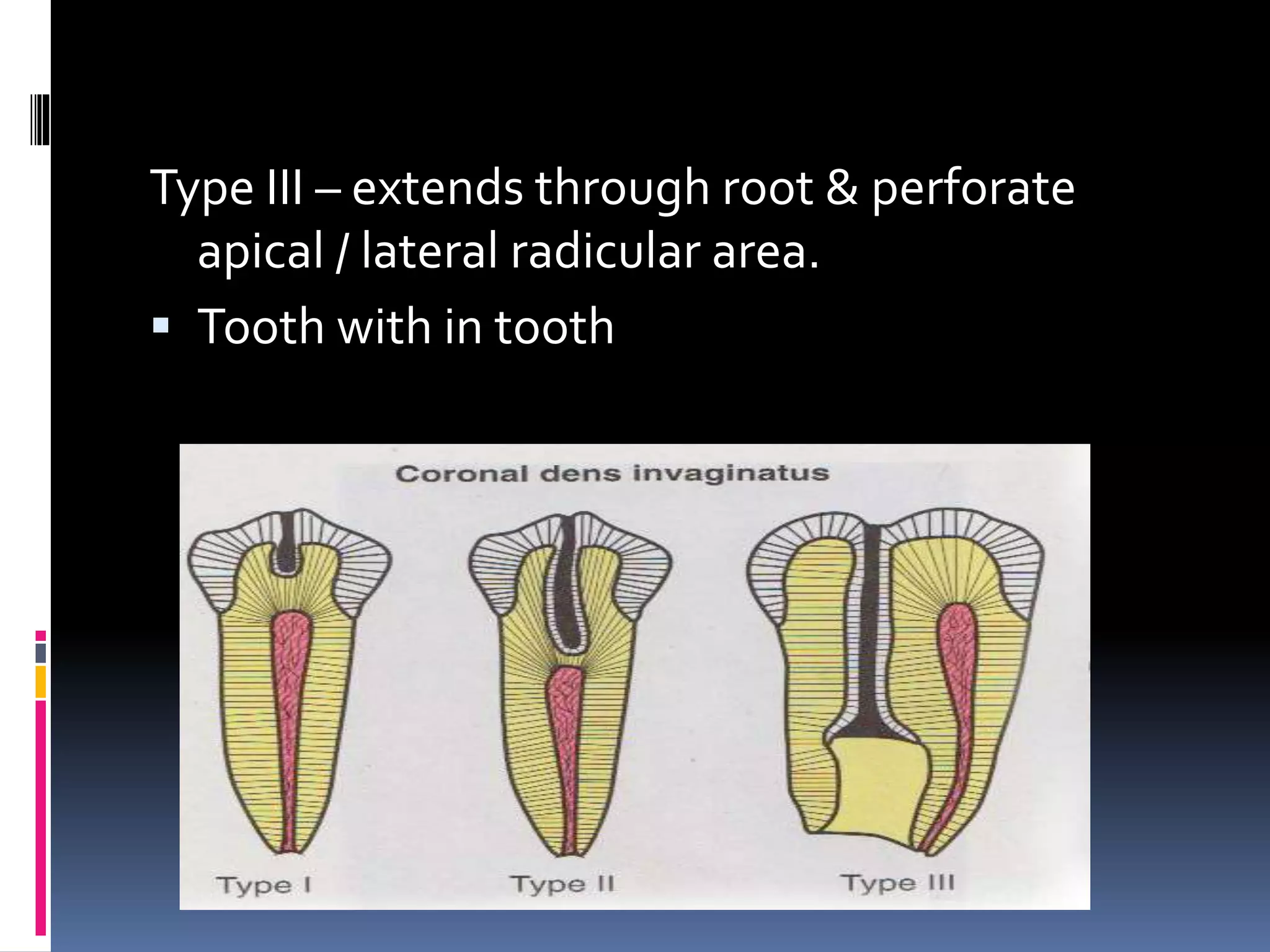 Type III – extends through root & perforate
apical / lateral radicular area.
 Tooth with in tooth
 