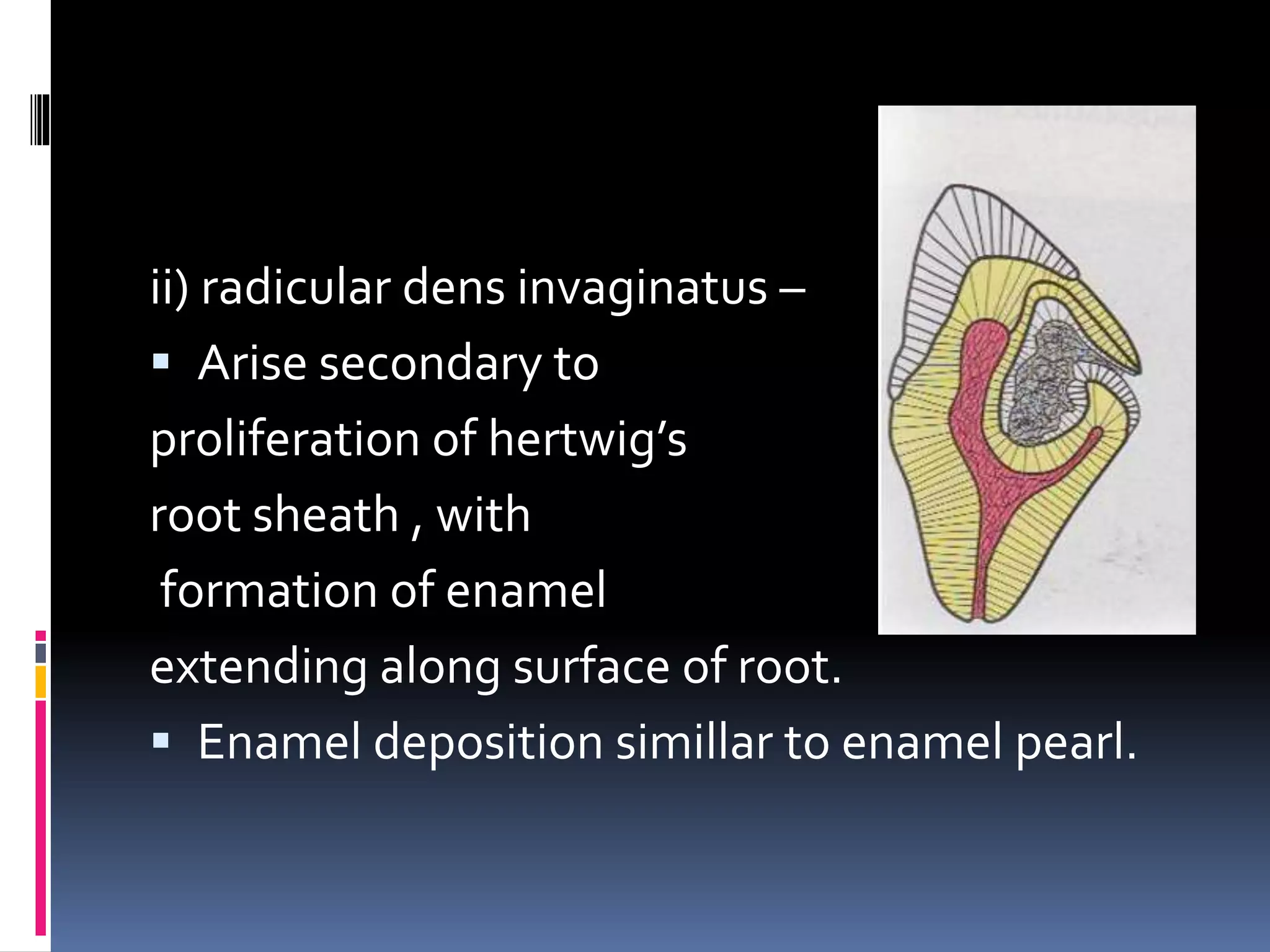 ii) radicular dens invaginatus –
 Arise secondary to
proliferation of hertwig’s
root sheath , with
formation of enamel
extending along surface of root.
 Enamel deposition simillar to enamel pearl.
 