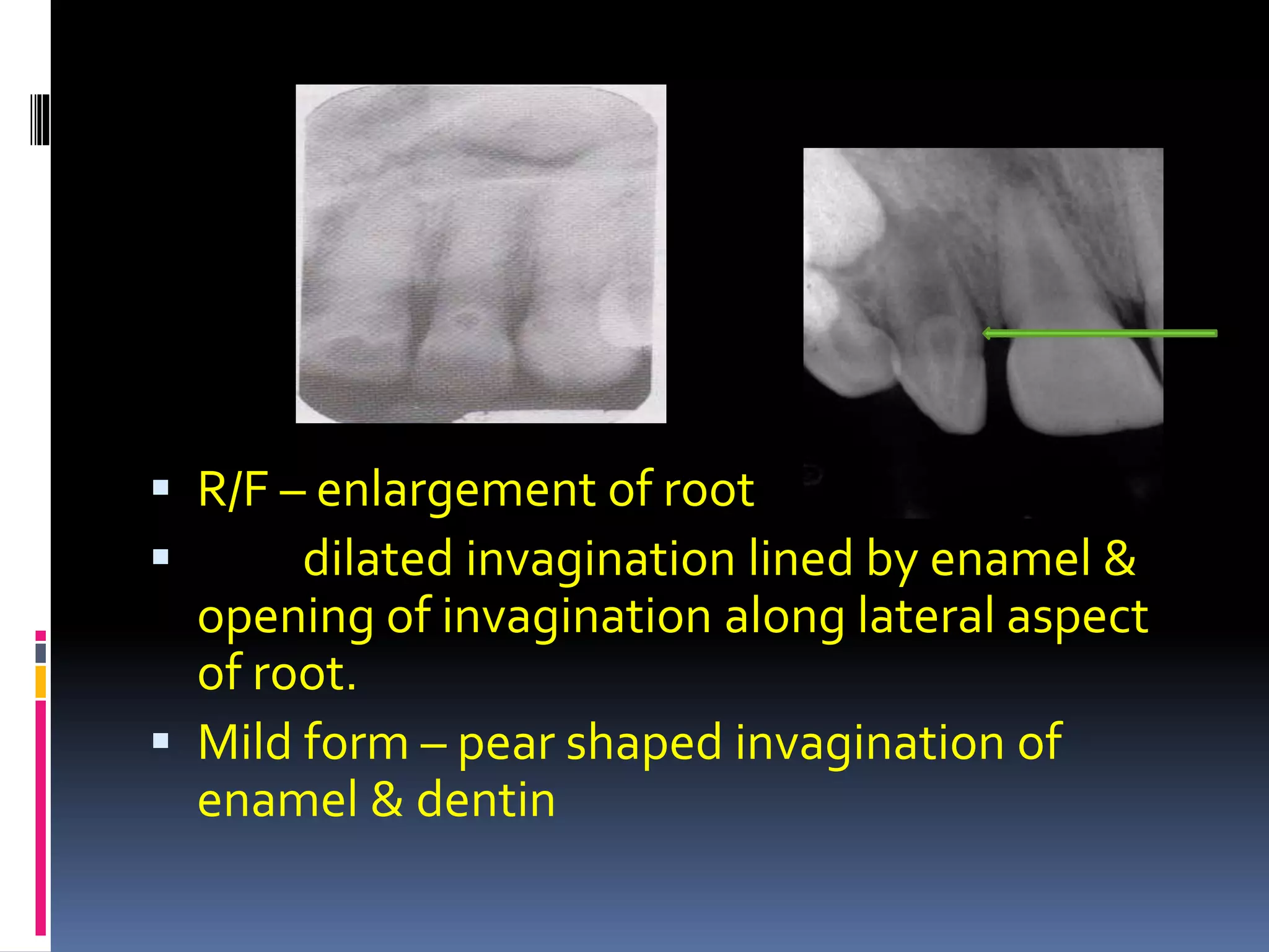  R/F – enlargement of root
 dilated invagination lined by enamel &
opening of invagination along lateral aspect
of root.
 Mild form – pear shaped invagination of
enamel & dentin
 