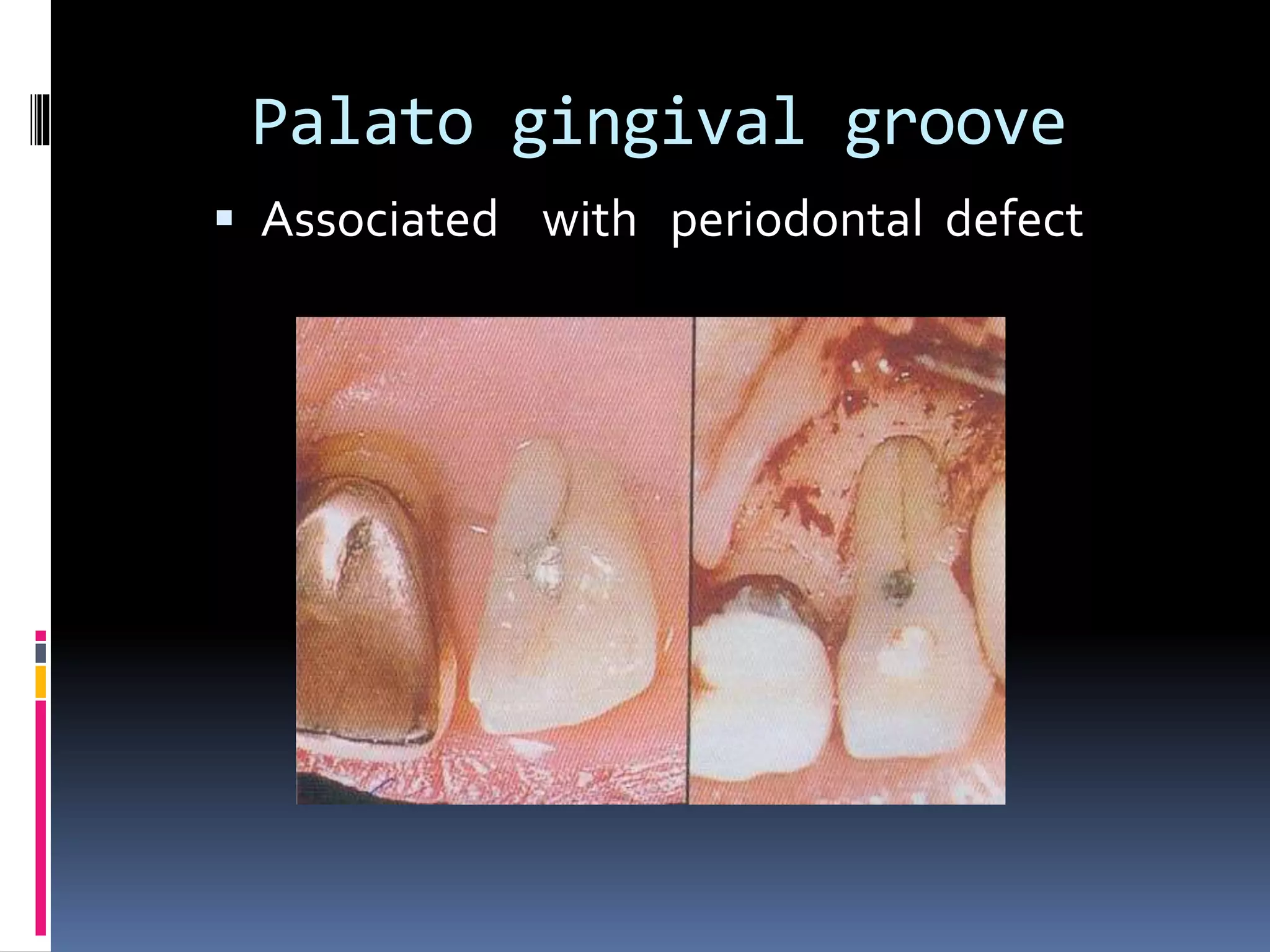 Palato gingival groove
 Associated with periodontal defect
 