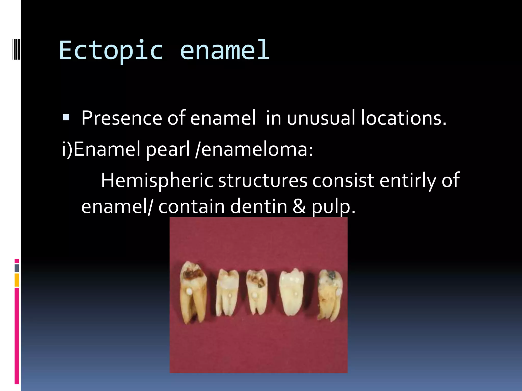 Ectopic enamel
 Presence of enamel in unusual locations.
i)Enamel pearl /enameloma:
Hemispheric structures consist entirly of
enamel/ contain dentin & pulp.
 