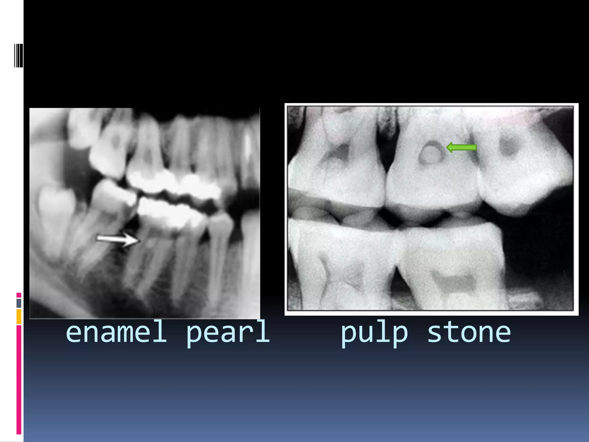 enamel pearl pulp stone
 