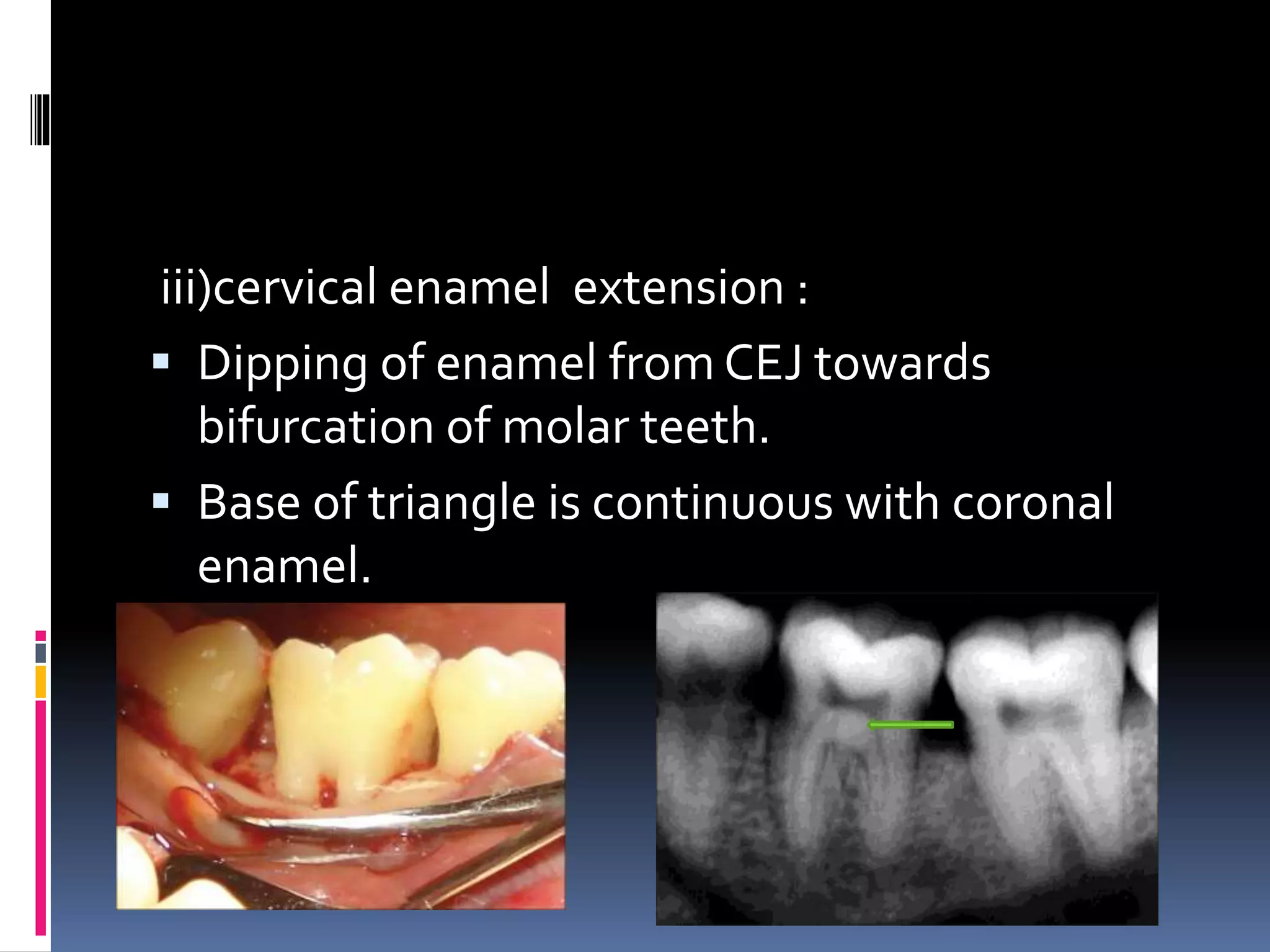 iii)cervical enamel extension :
 Dipping of enamel from CEJ towards
bifurcation of molar teeth.
 Base of triangle is continuous with coronal
enamel.
 
