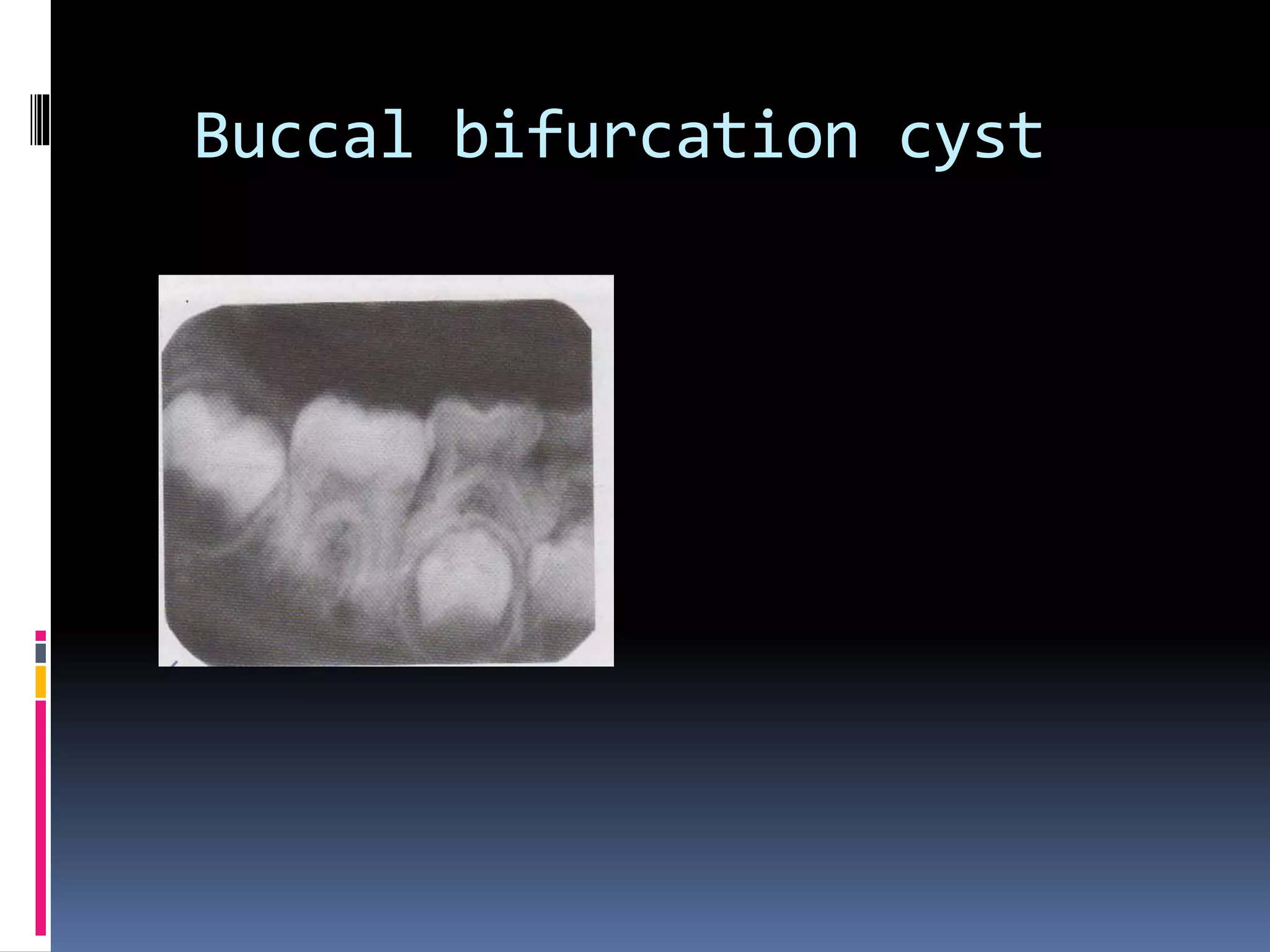 Buccal bifurcation cyst
 